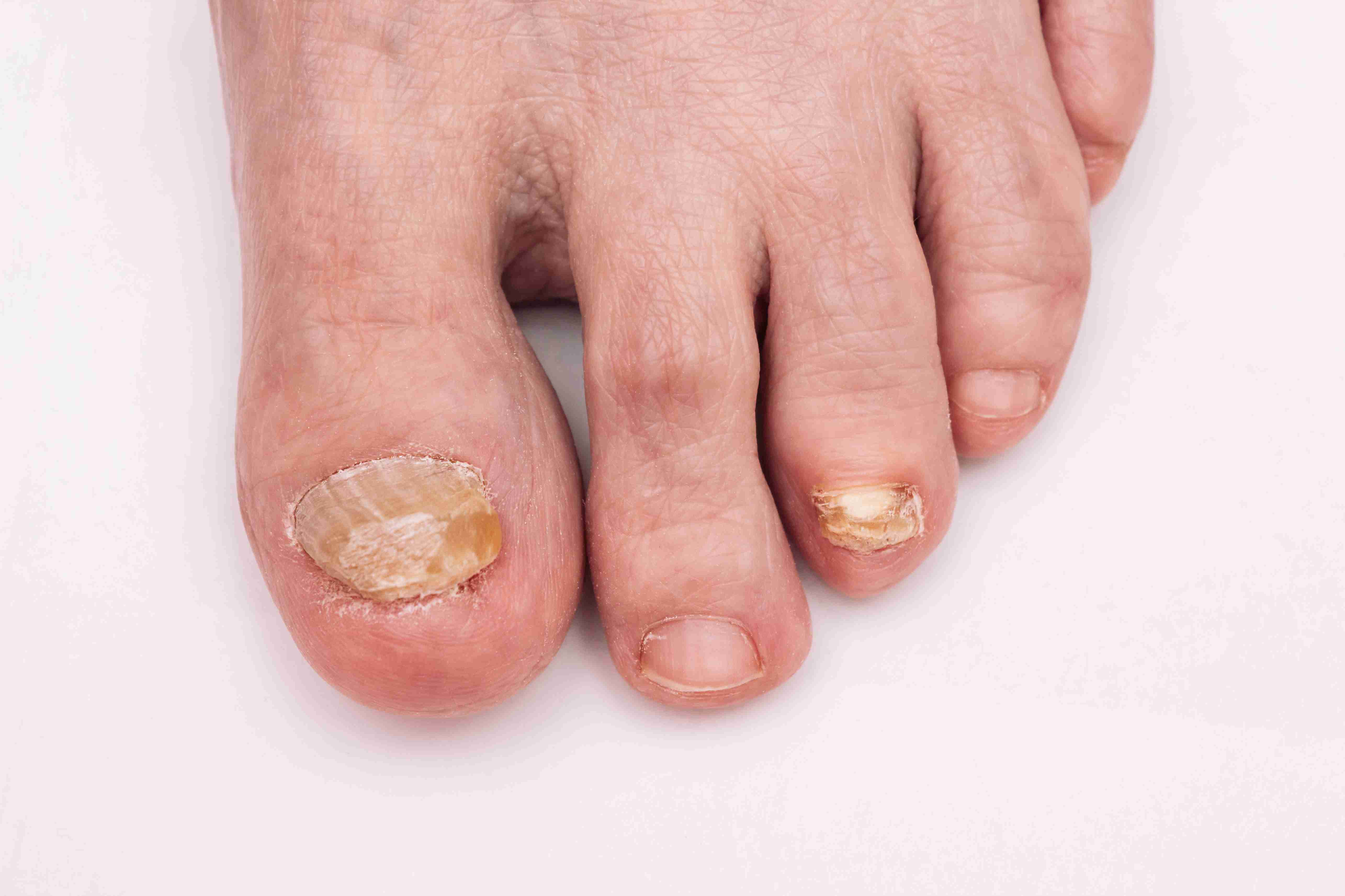 Stepwise care for ingrown toenails