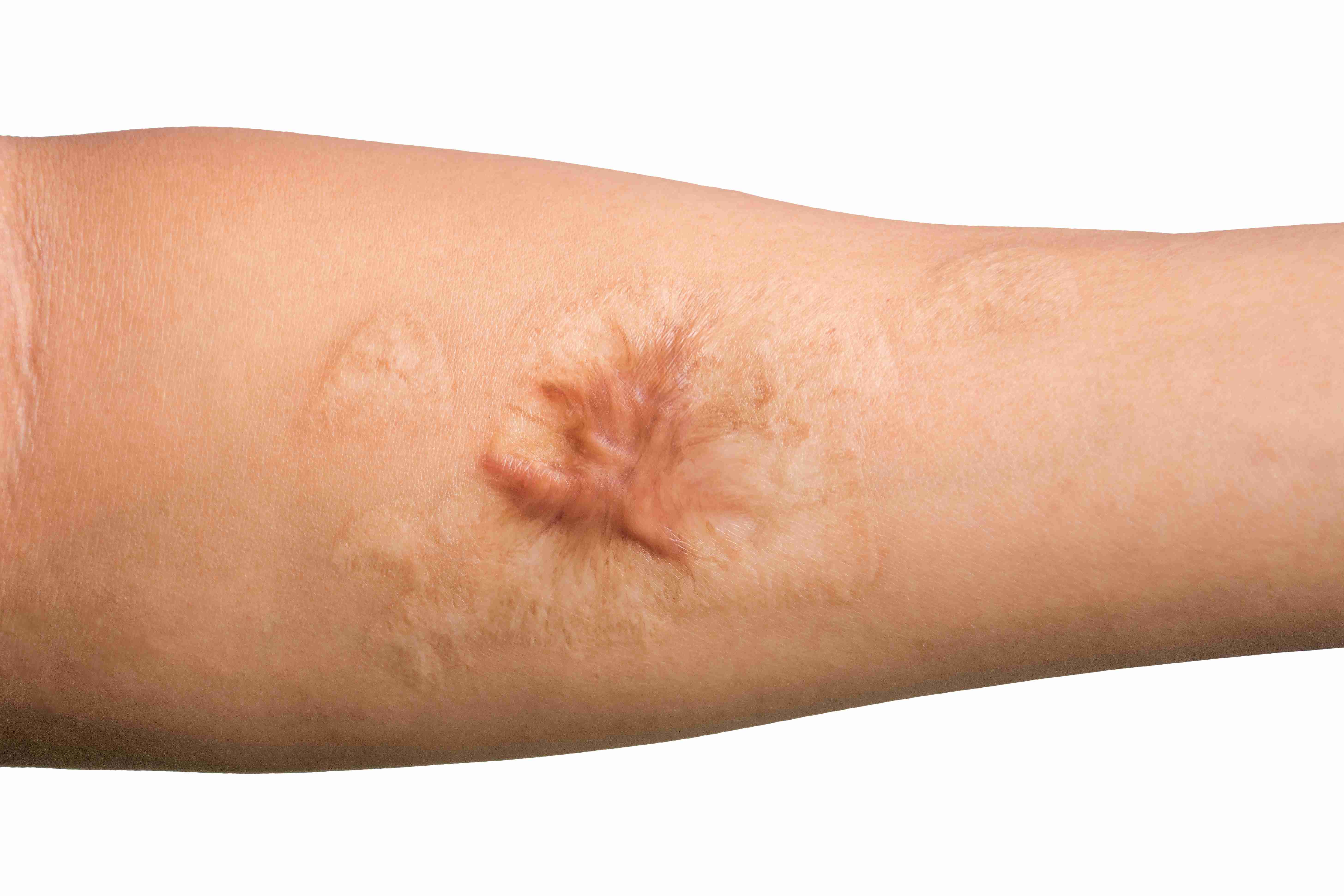 Thick keloid scar on shoulder area