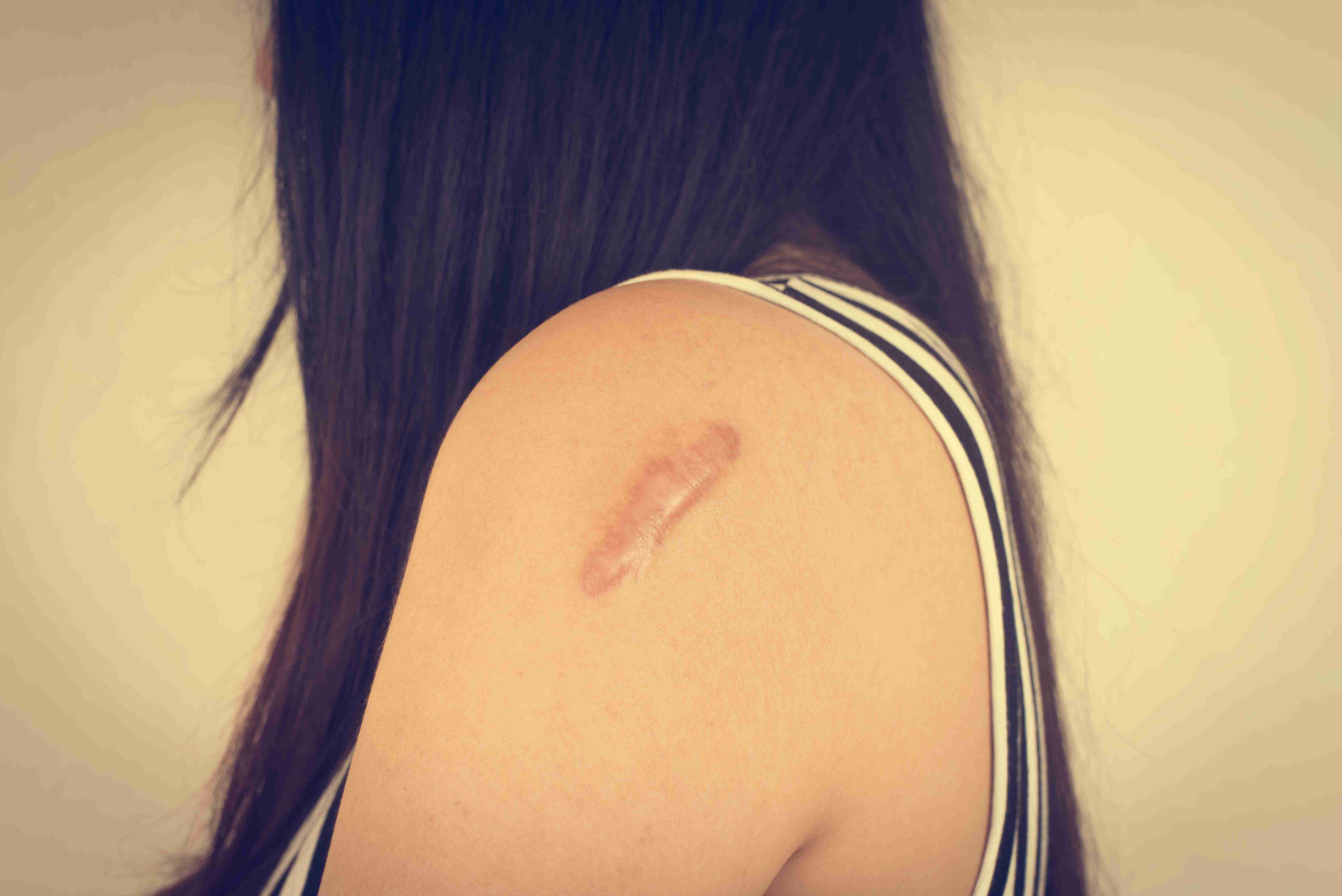 Collagen buildup and keloid scar pathogenesis