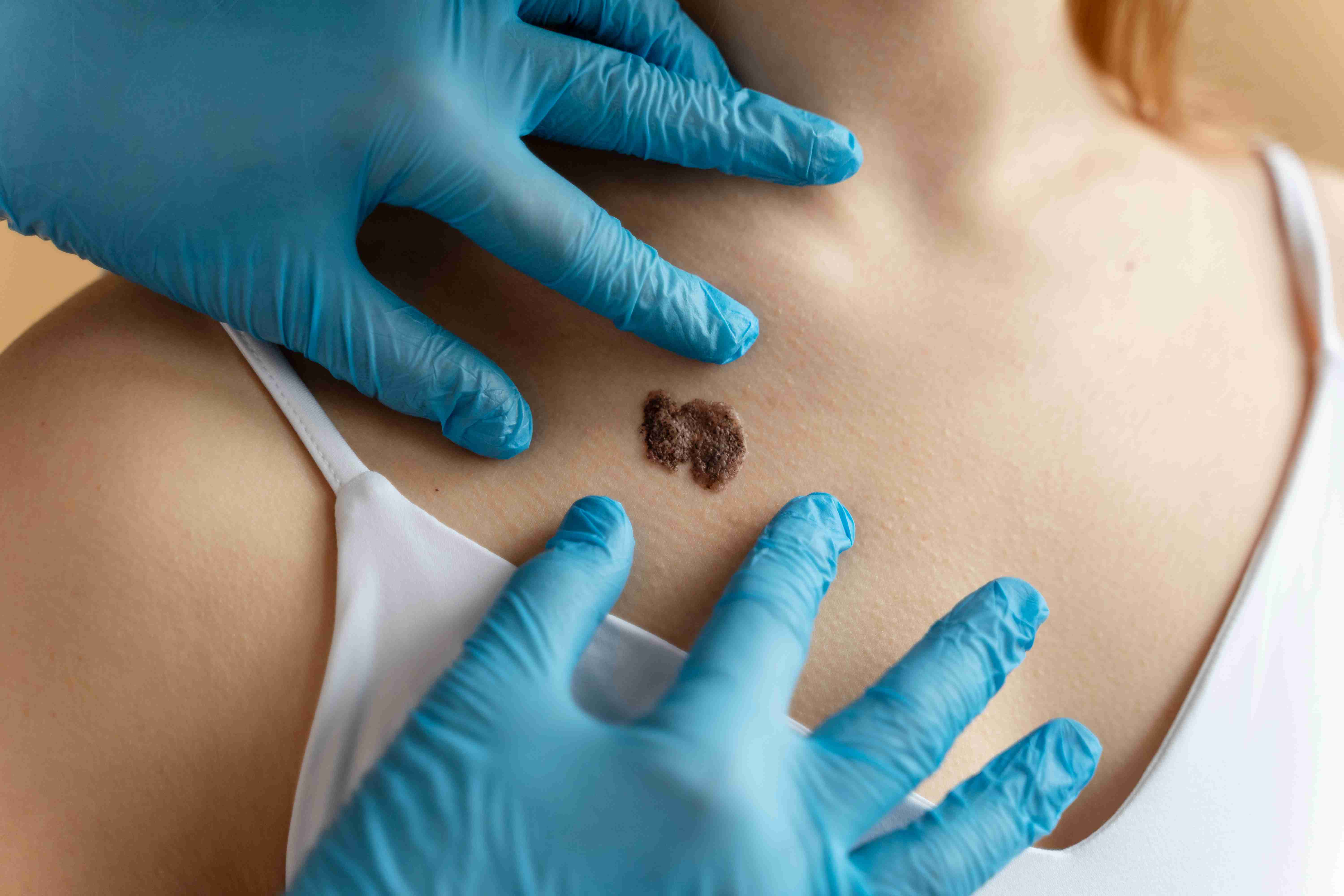 Steroid and cryotherapy treatment for keloids