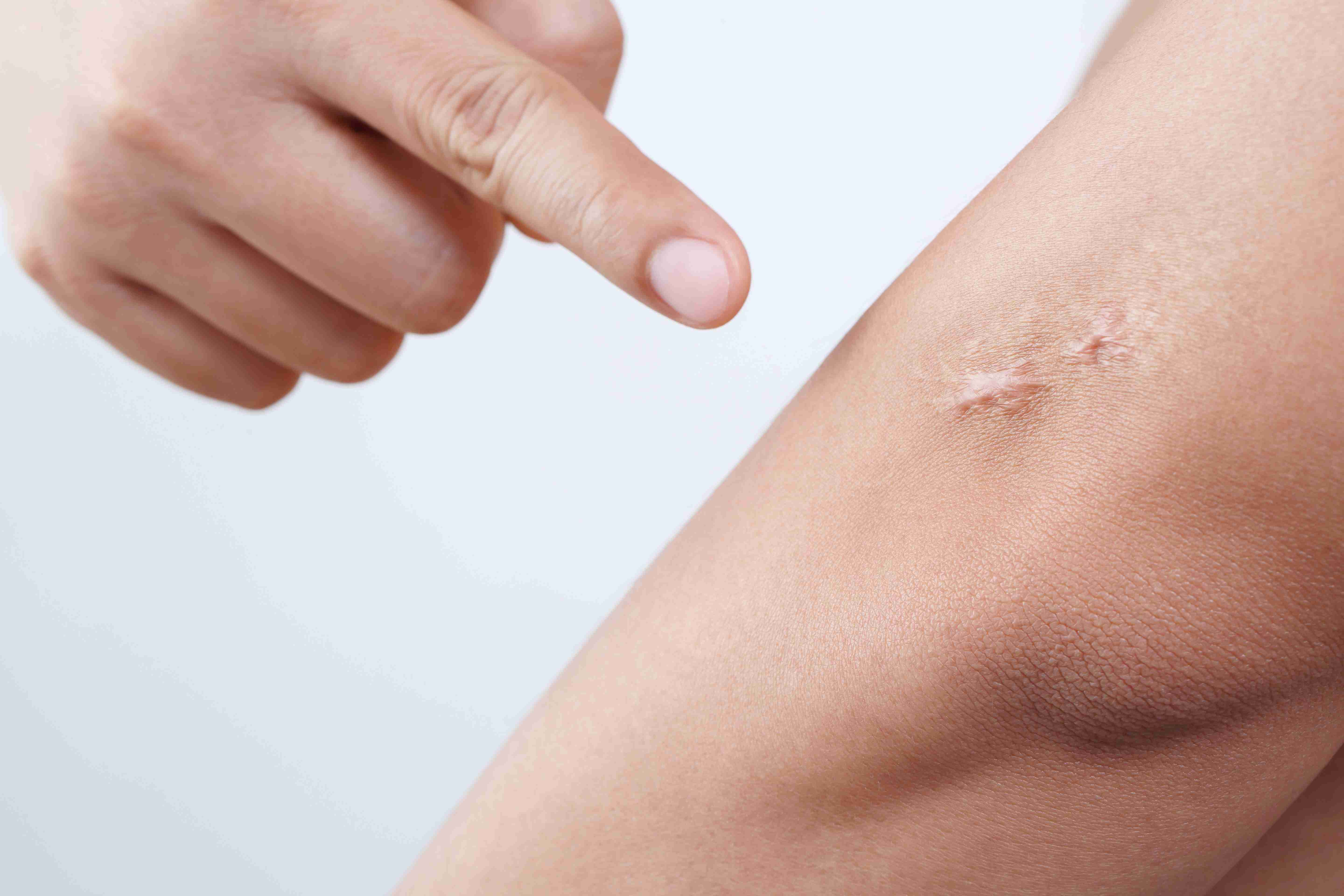 Steps in keloid treatment and prevention