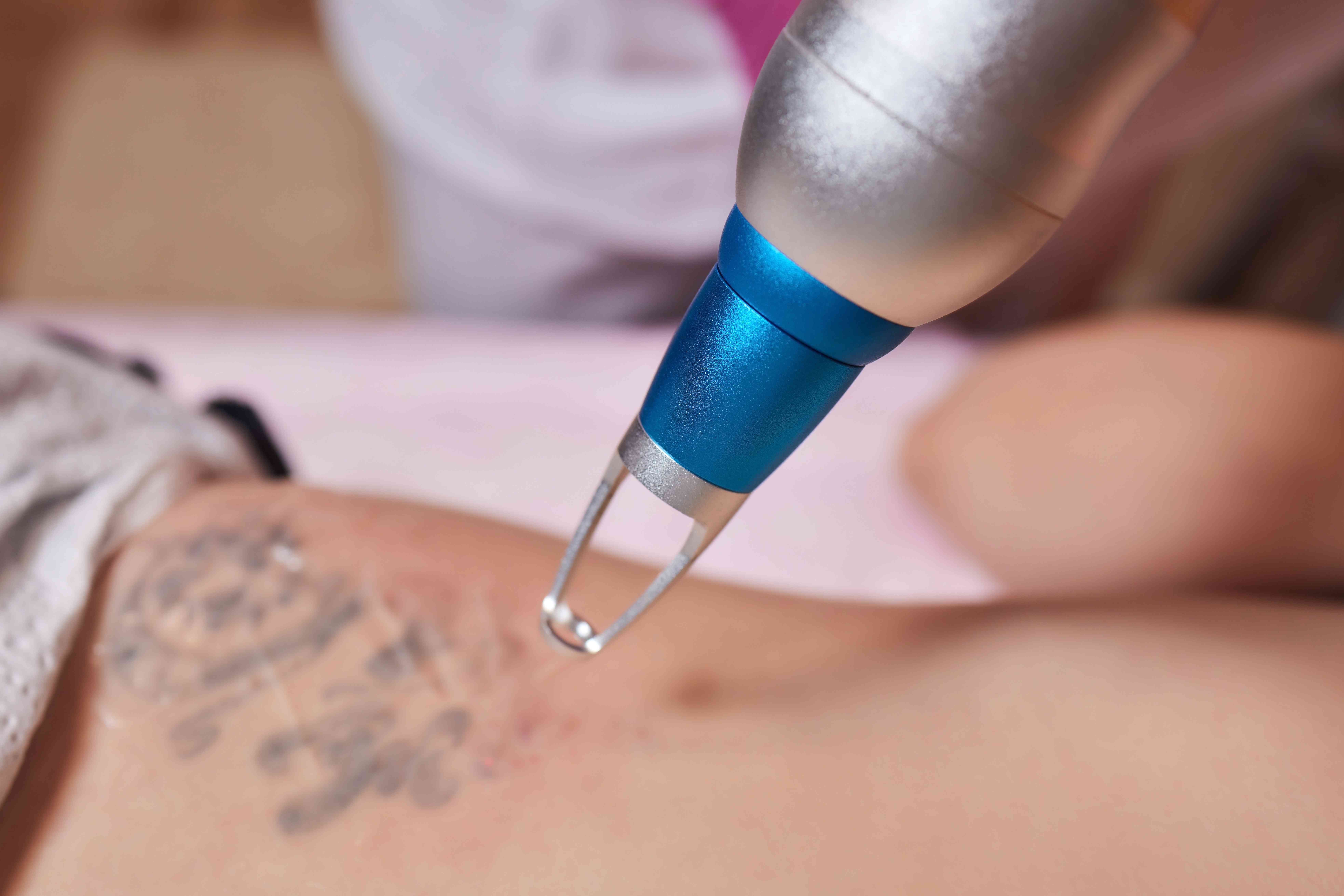 Ideal candidates for tattoo removal
