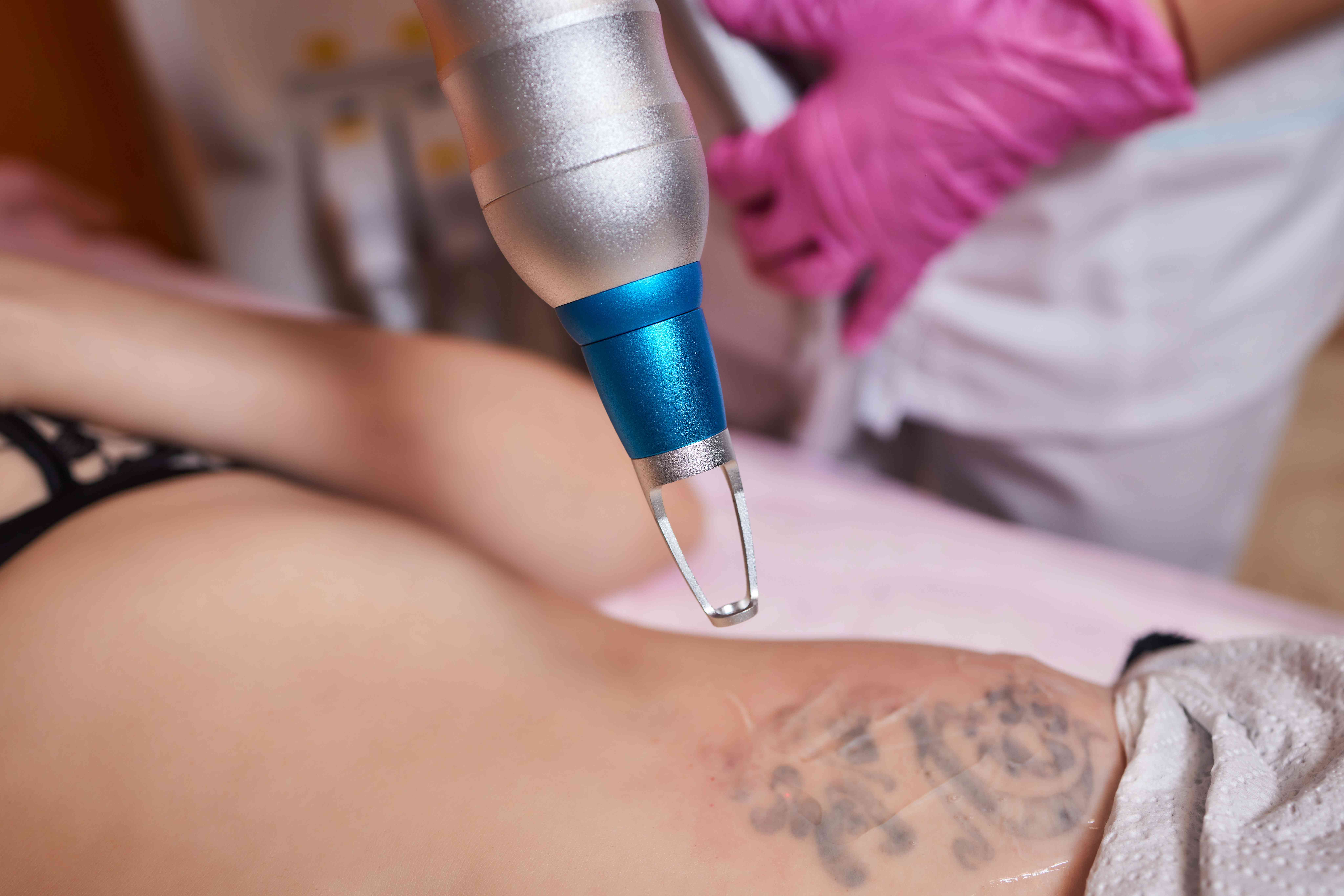 Laser session and post-care