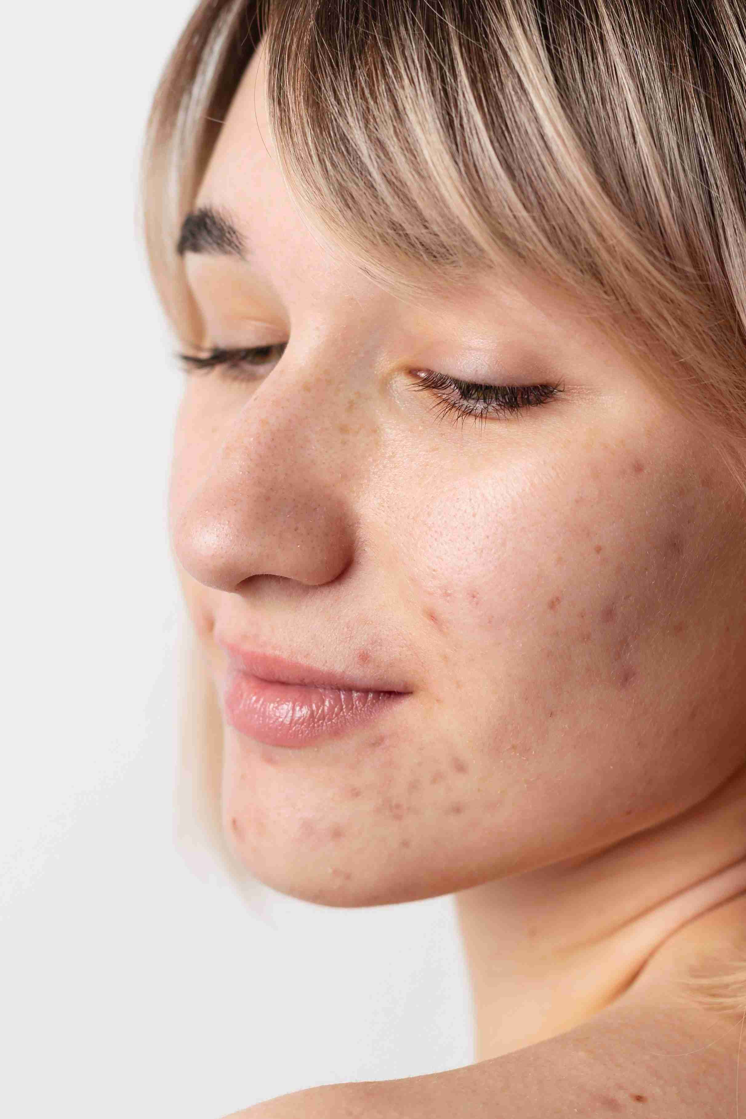 Melasma