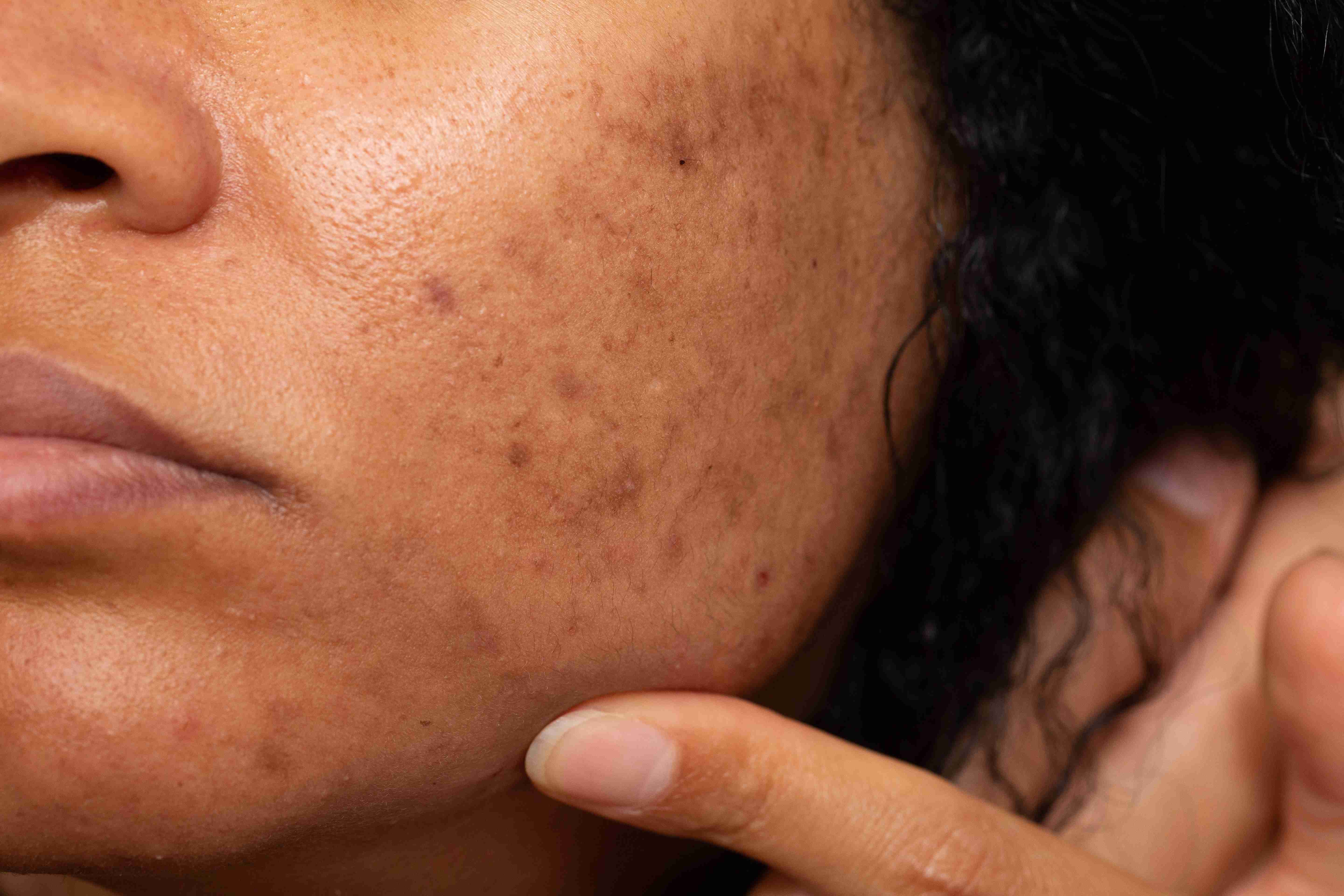 Melasma on cheeks and forehead