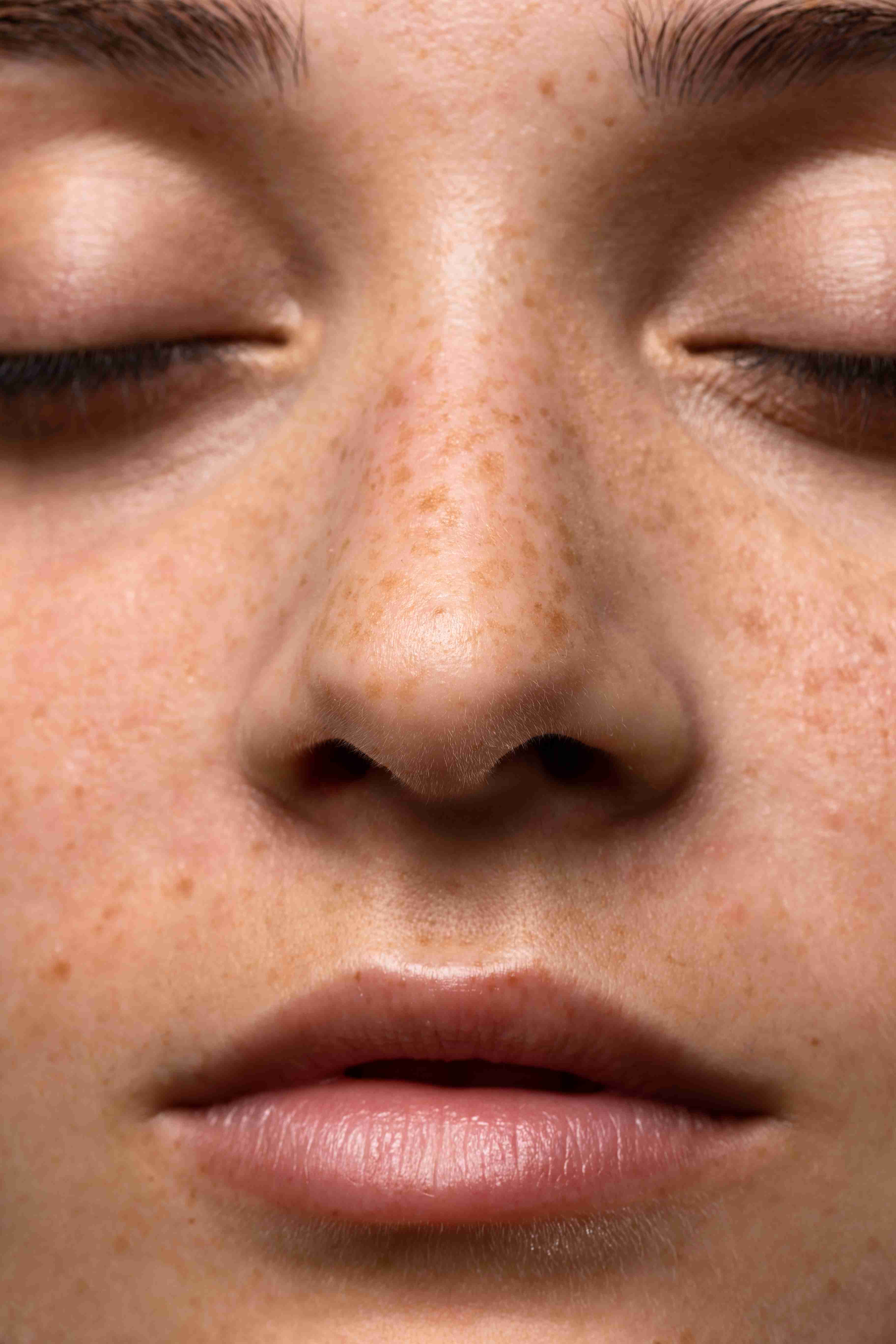 Melasma patches under light