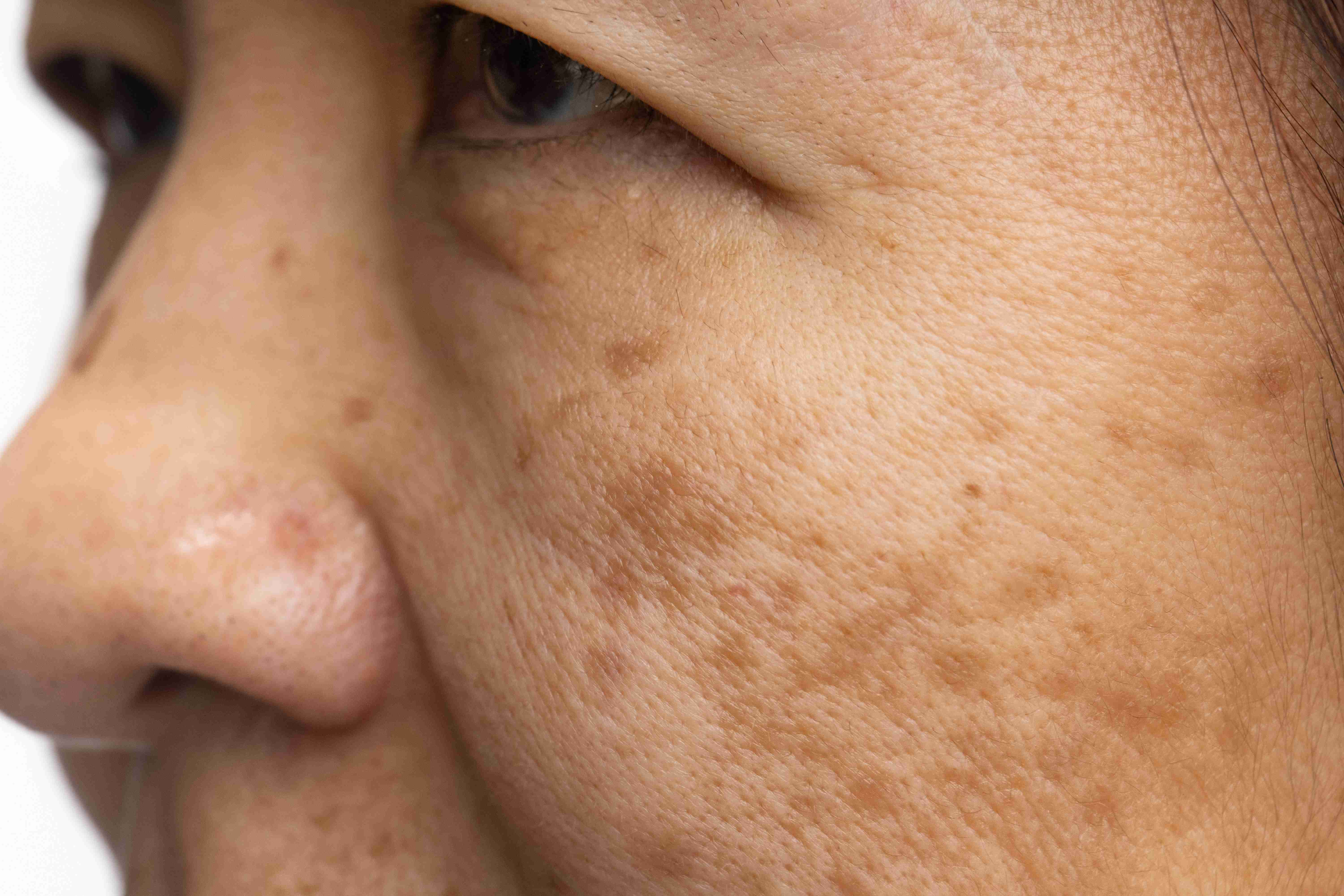 Melasma laser and peel treatment