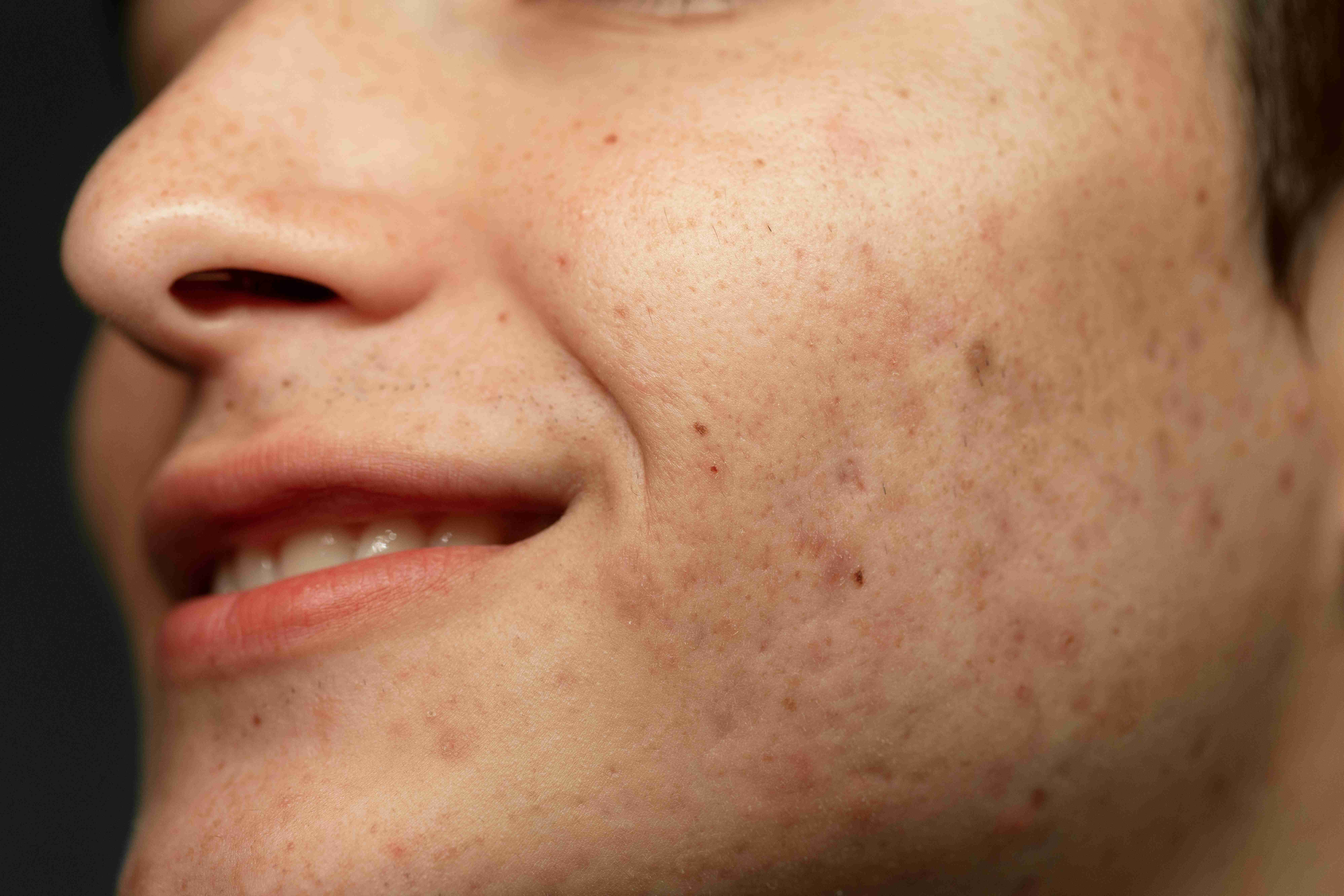 Even skin tone after melasma treatment