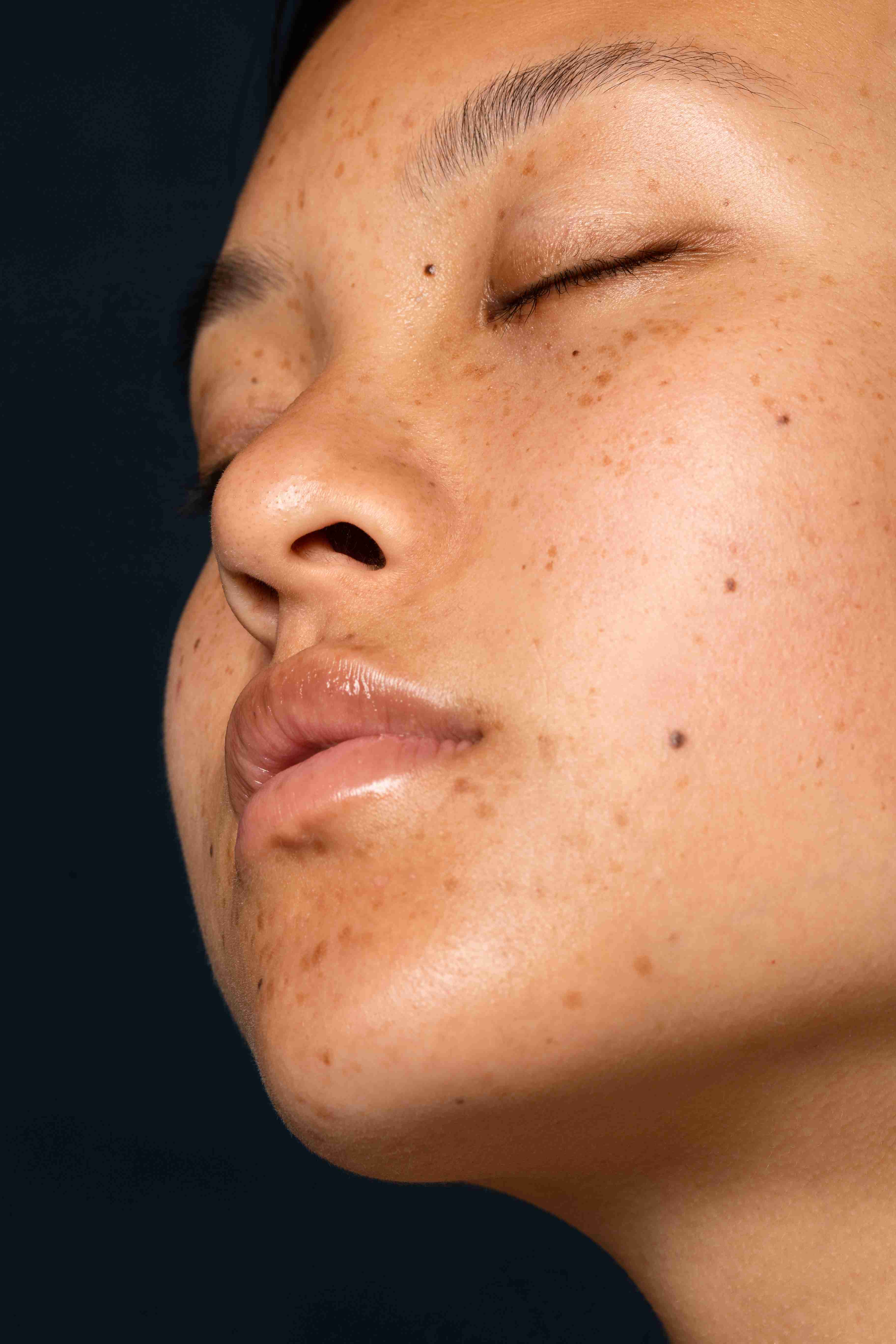 Melasma on forehead and cheeks