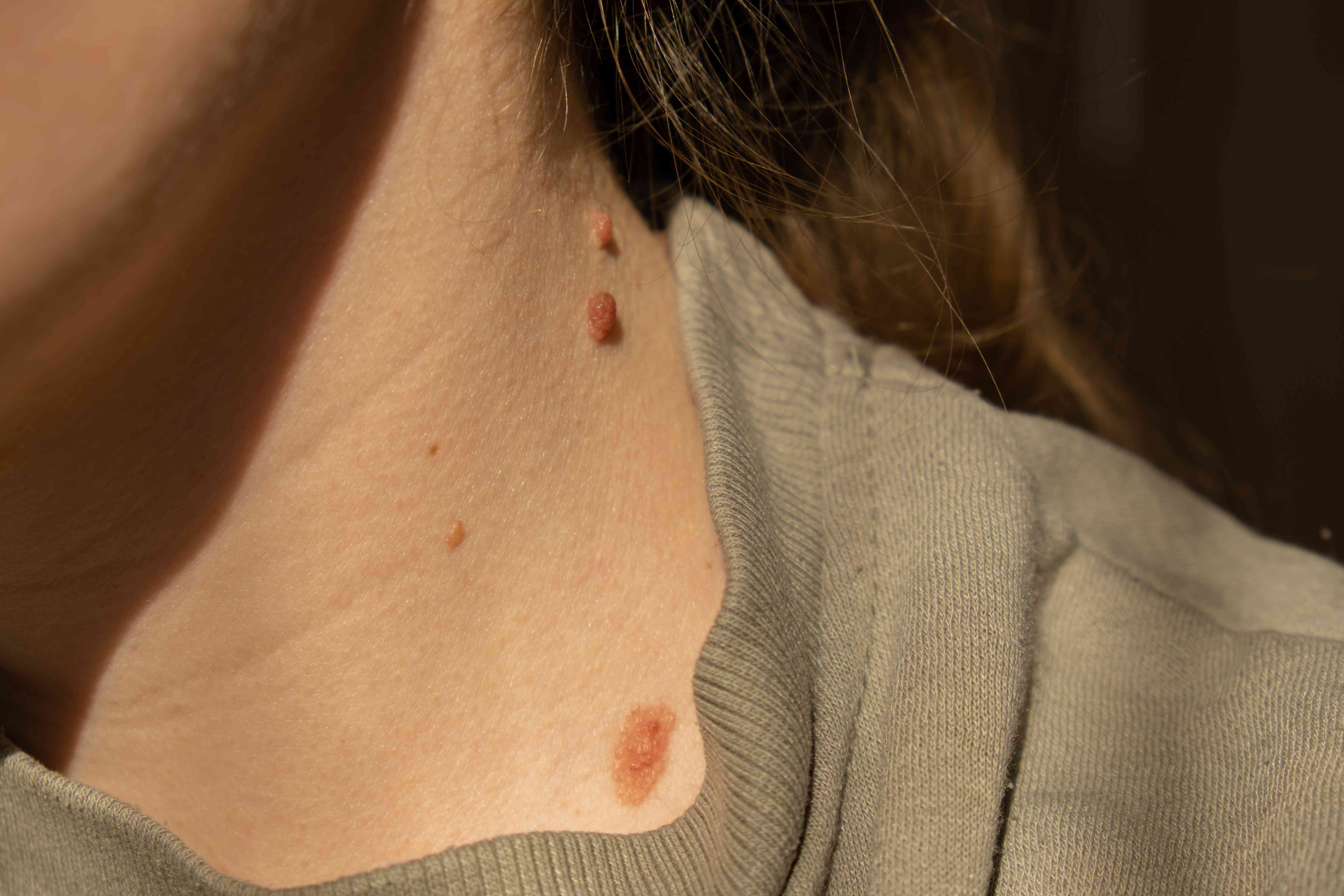 Various types of moles on skin