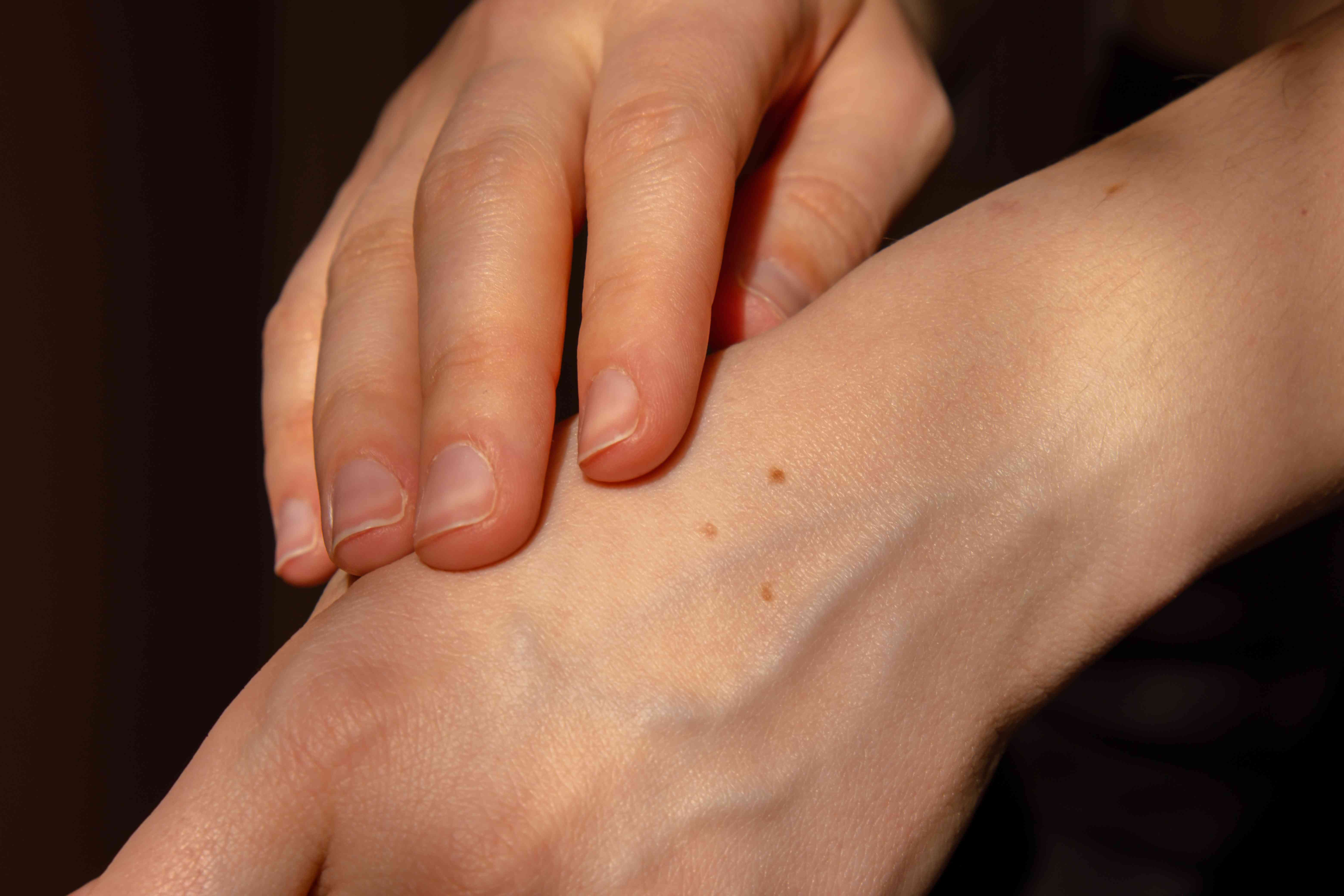 Causes of mole formation