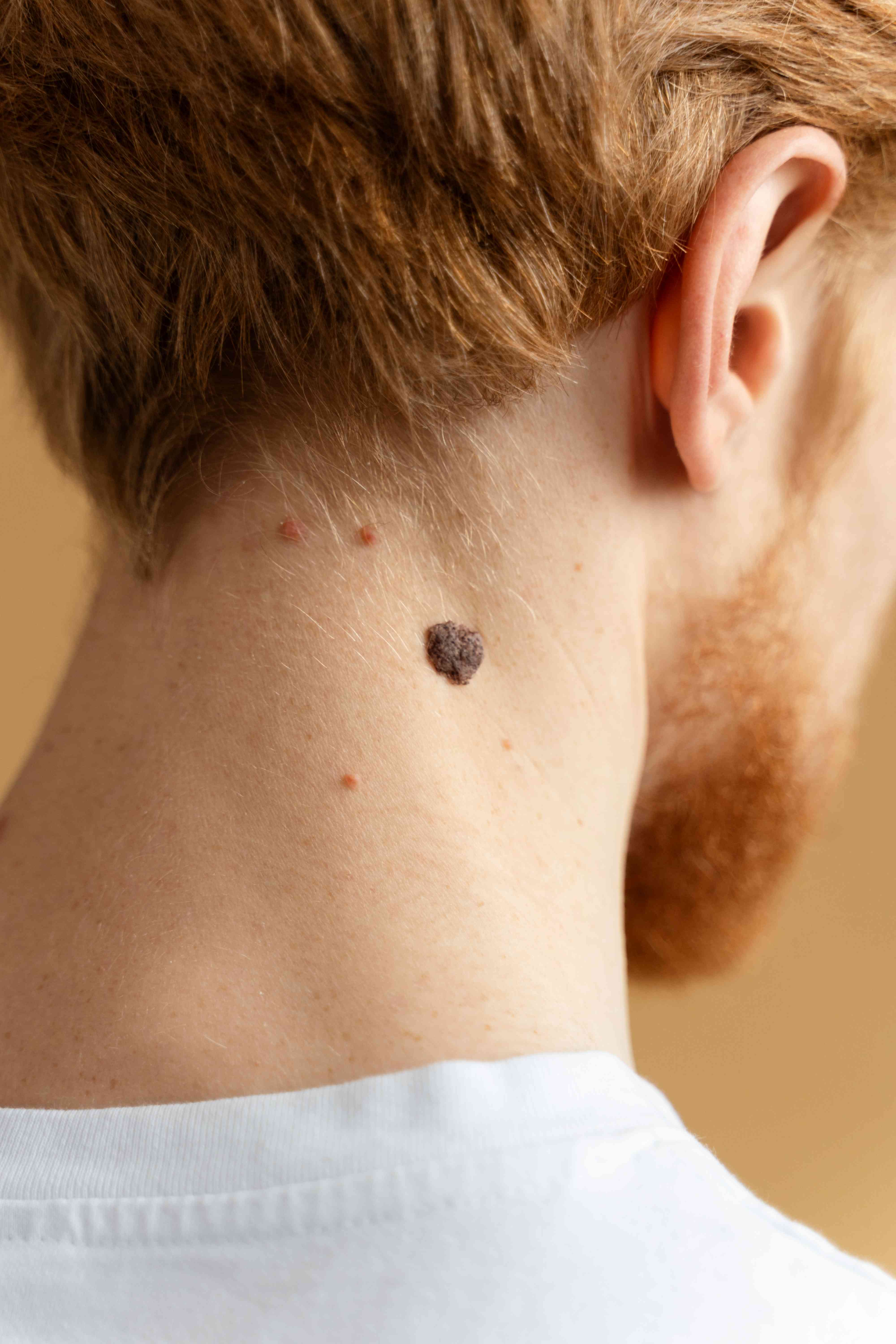 Techniques used for mole removal
