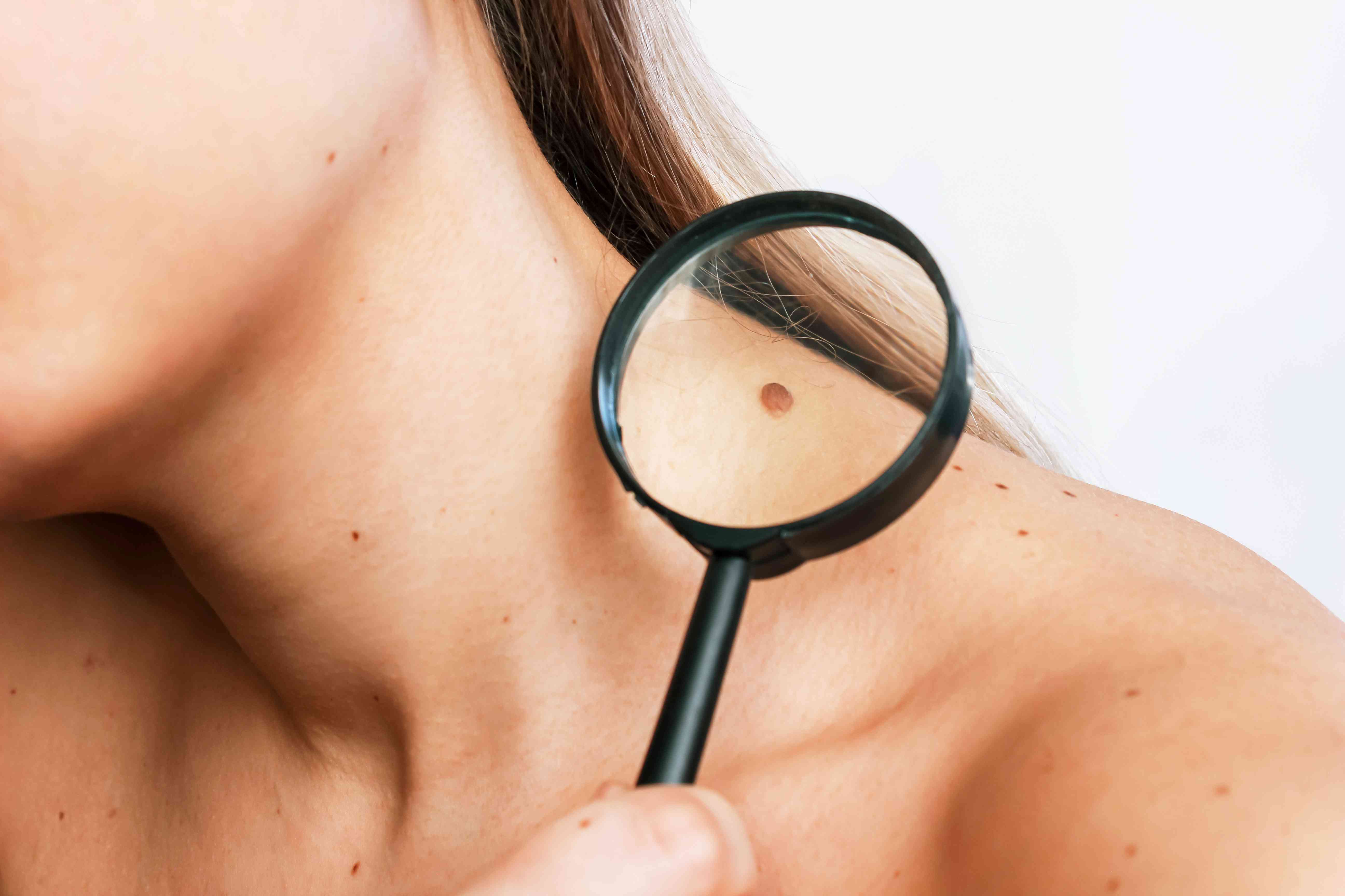 Consultation for mole removal