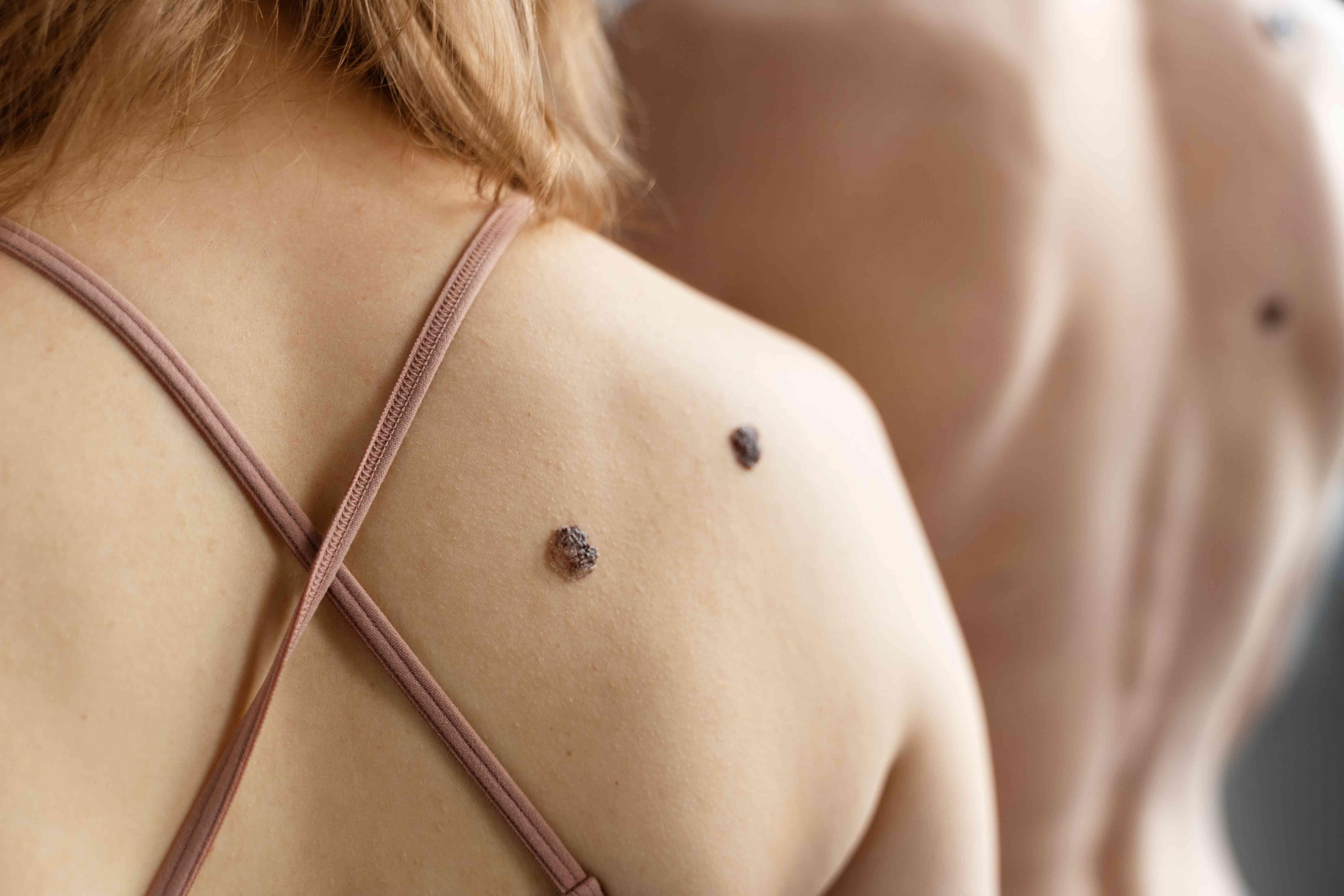 Step-by-step mole removal