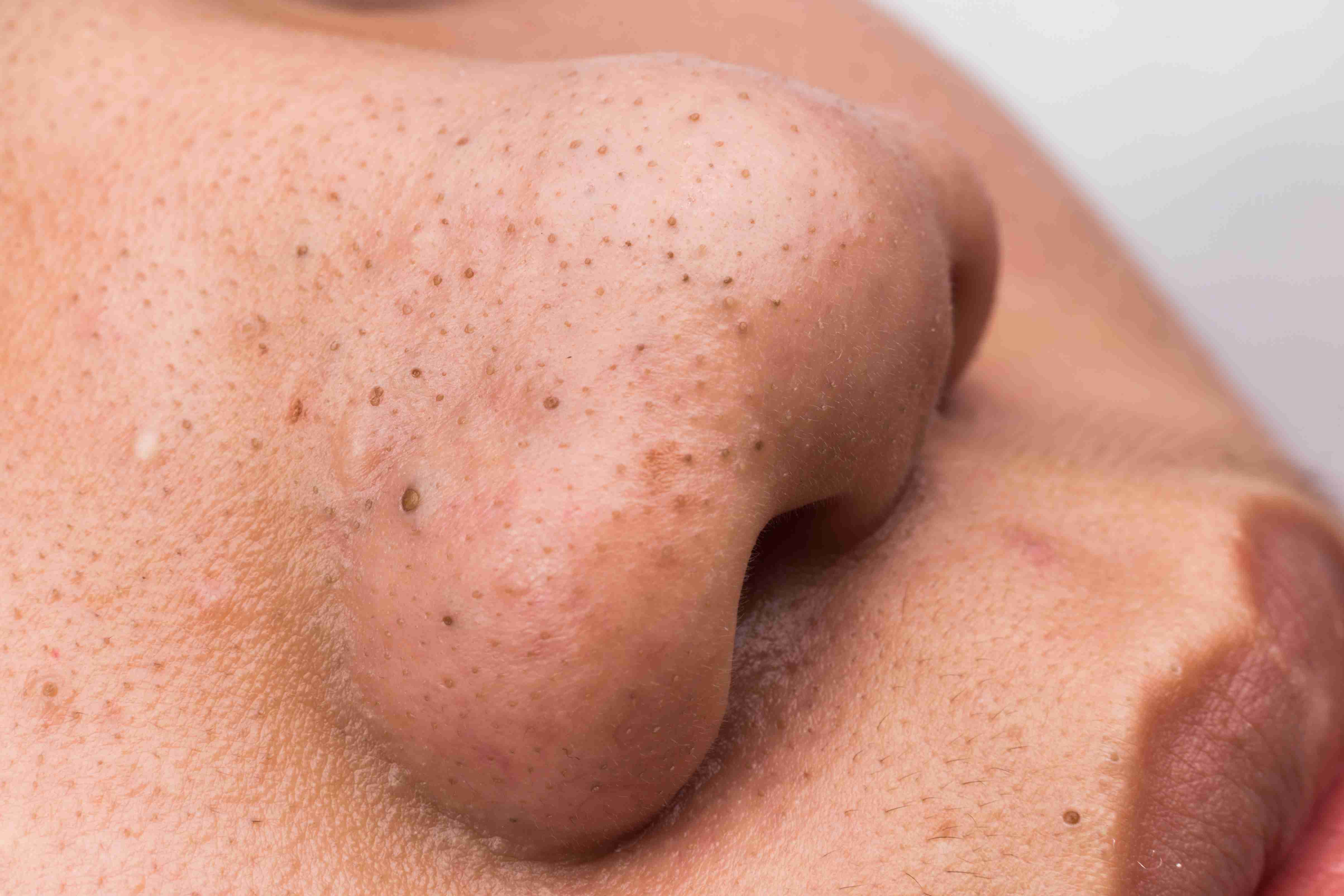 Visible open pores on the cheeks and nose