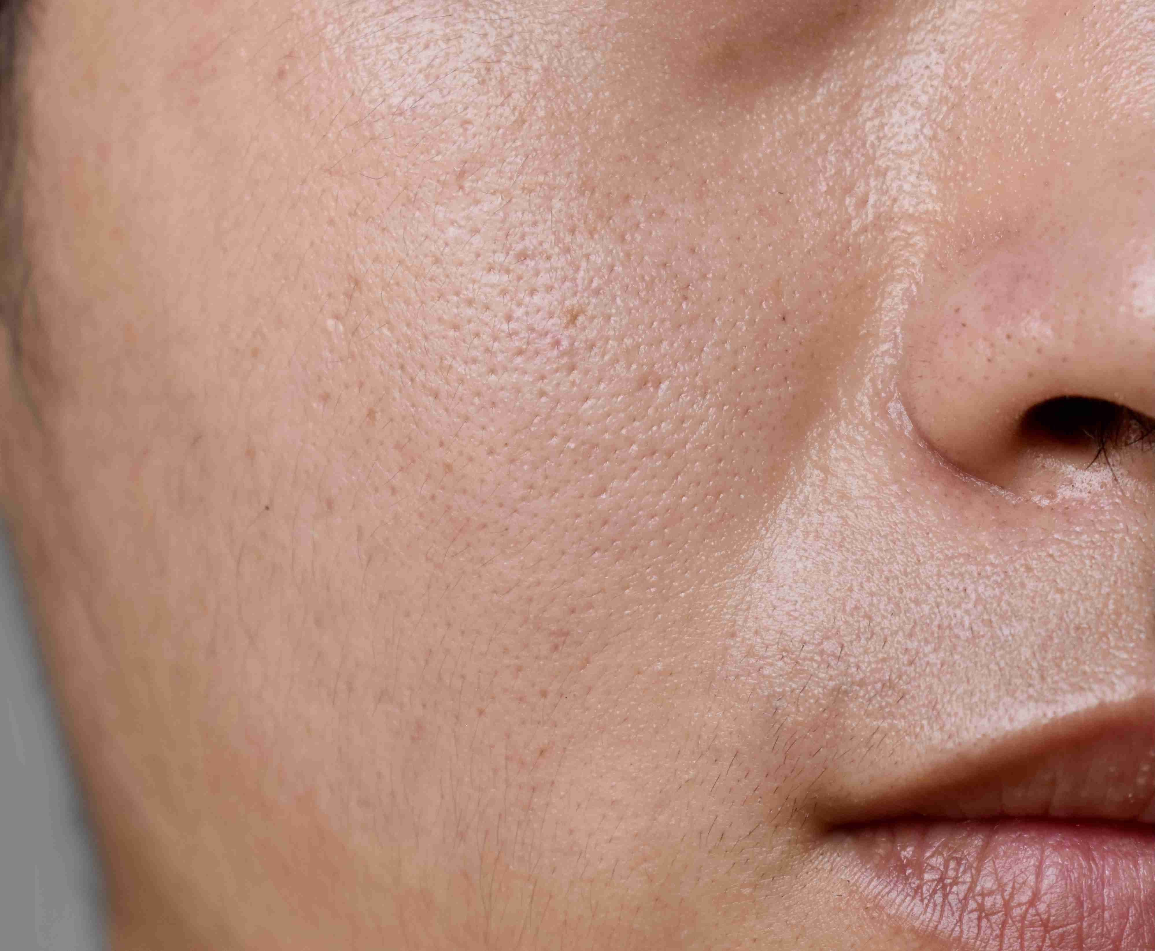 Enlarged pores caused by oil and sun exposure