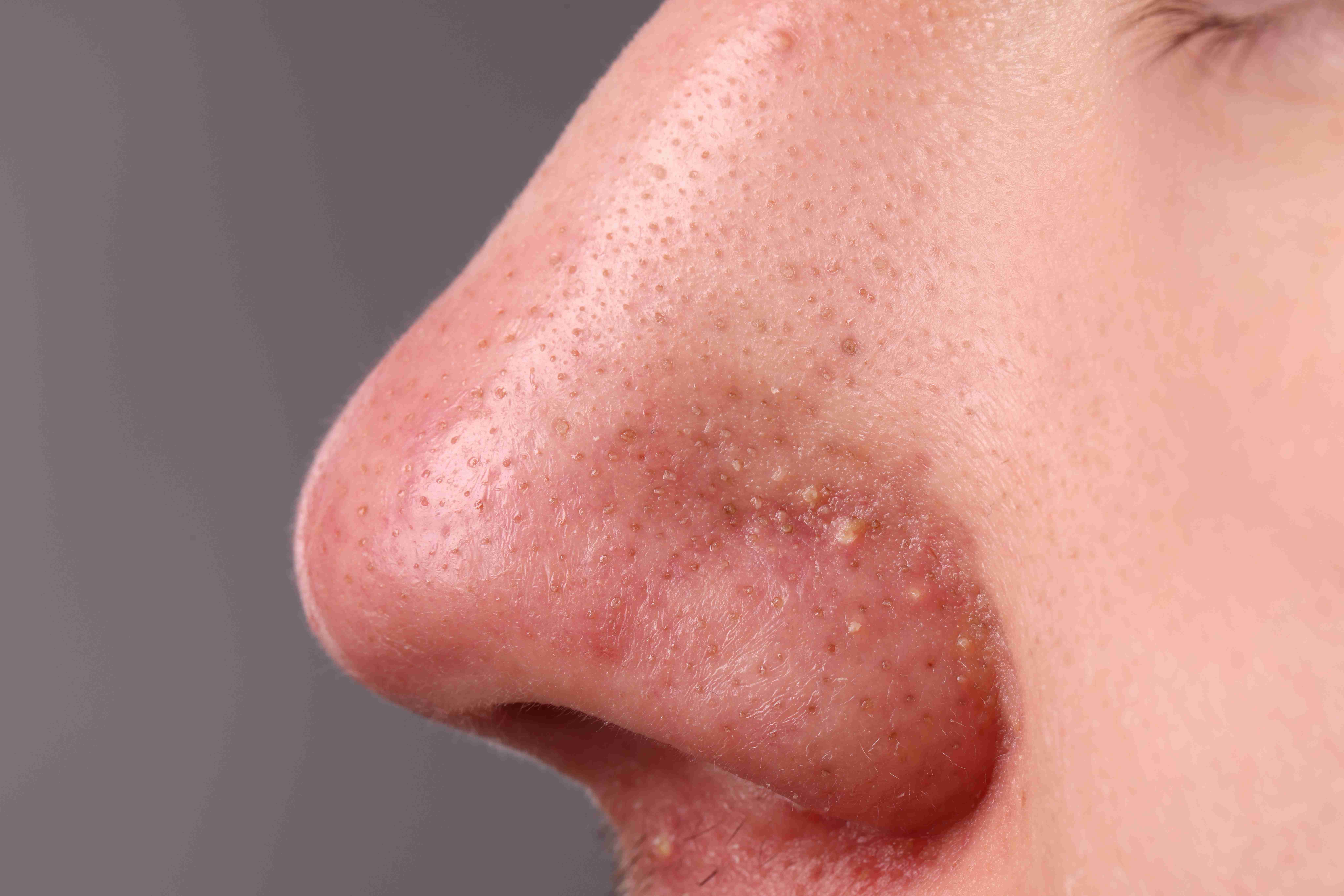 Microneedling and peel treatments for pore tightening