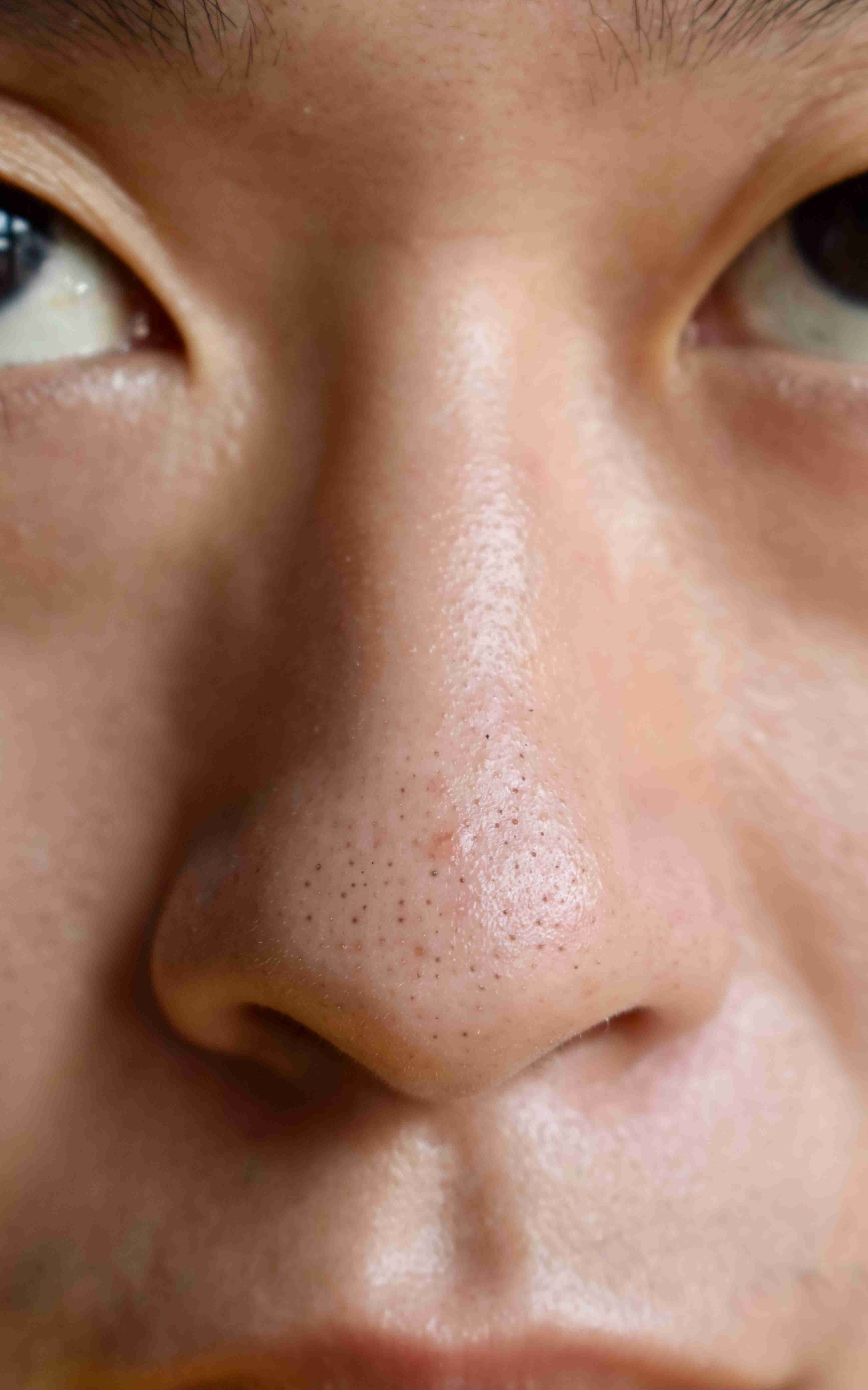 Dermatologist examining facial pores