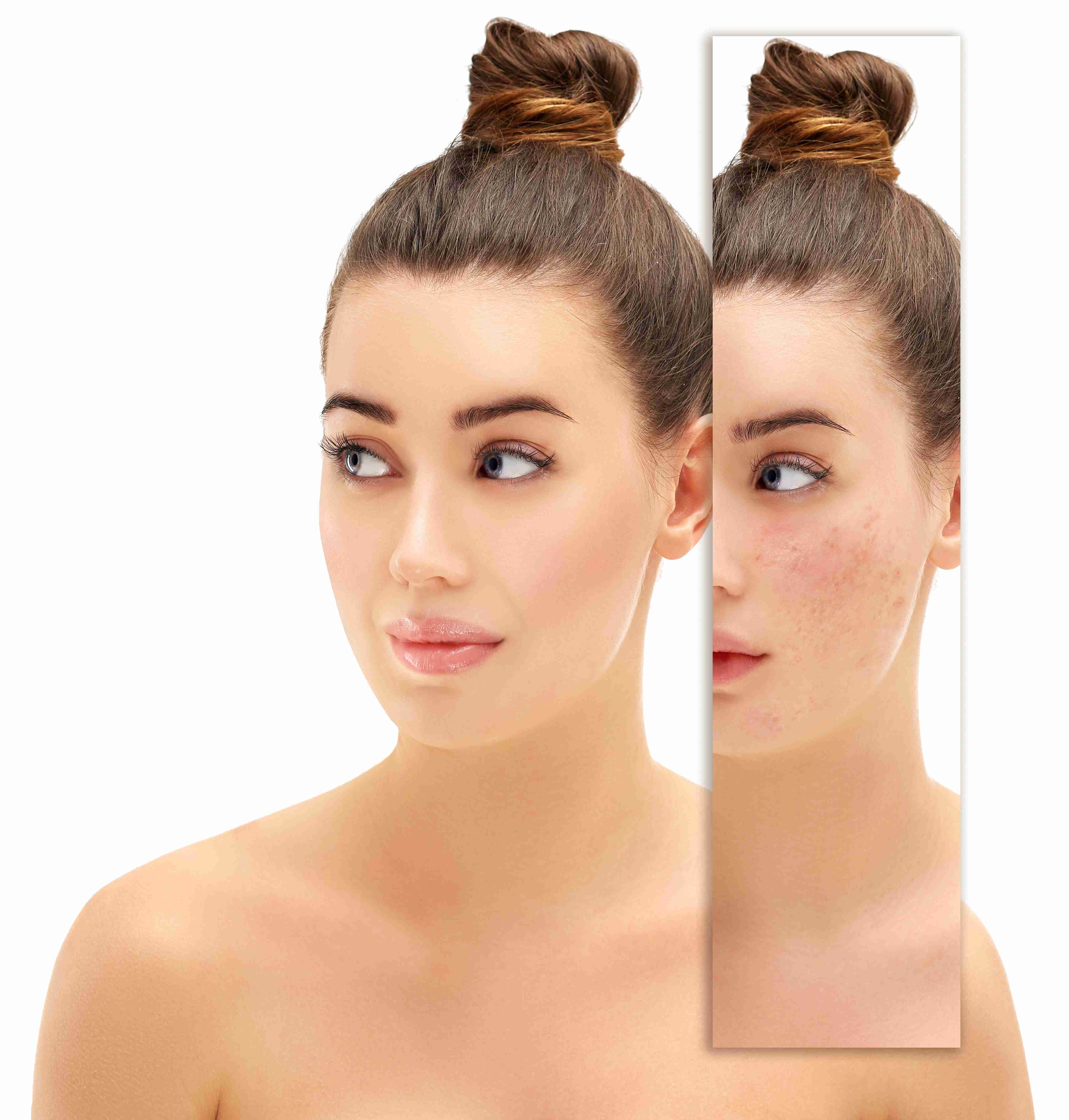 Before and after of facial pigmentation removal