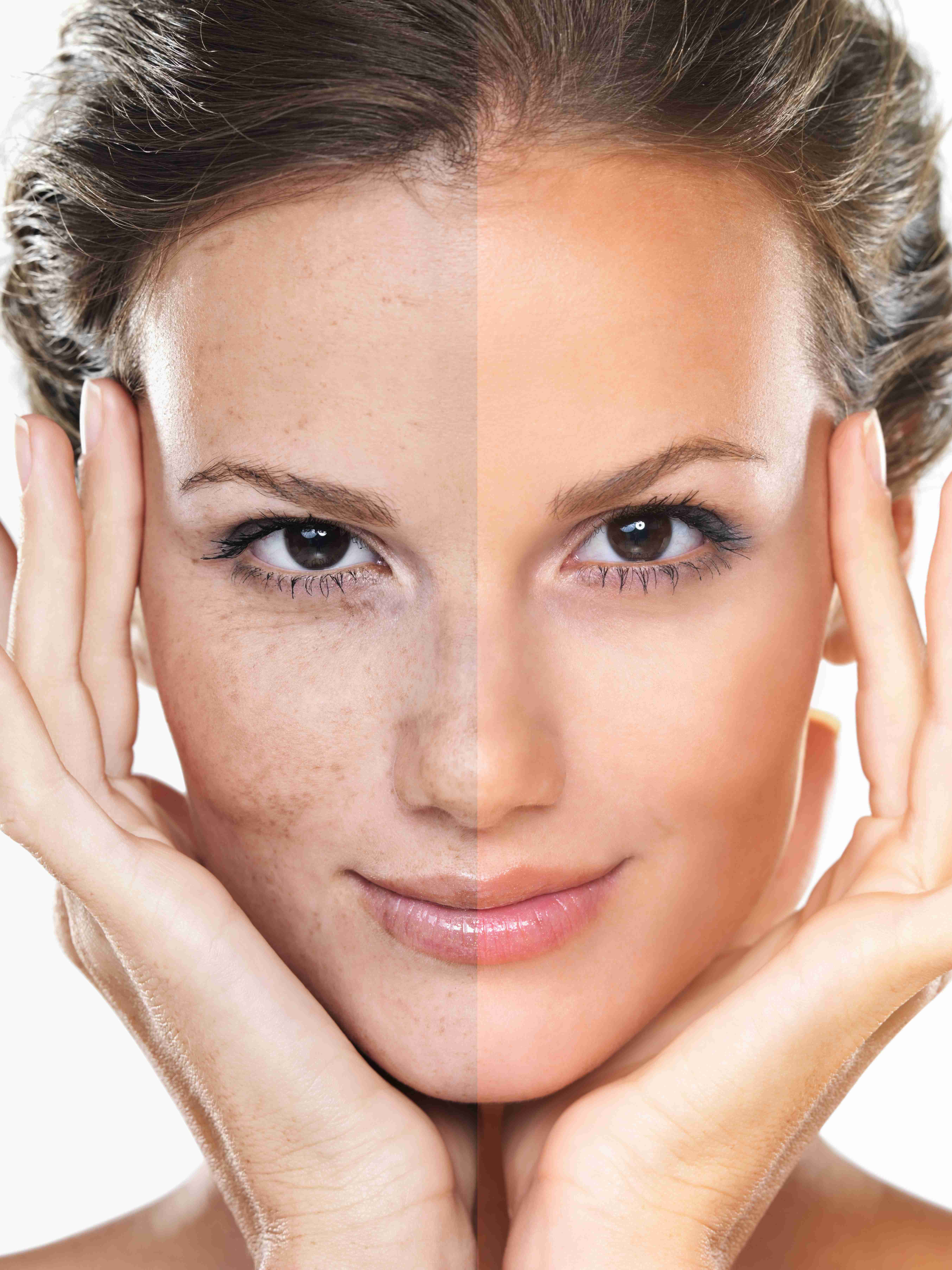 Hyperpigmentation areas on face