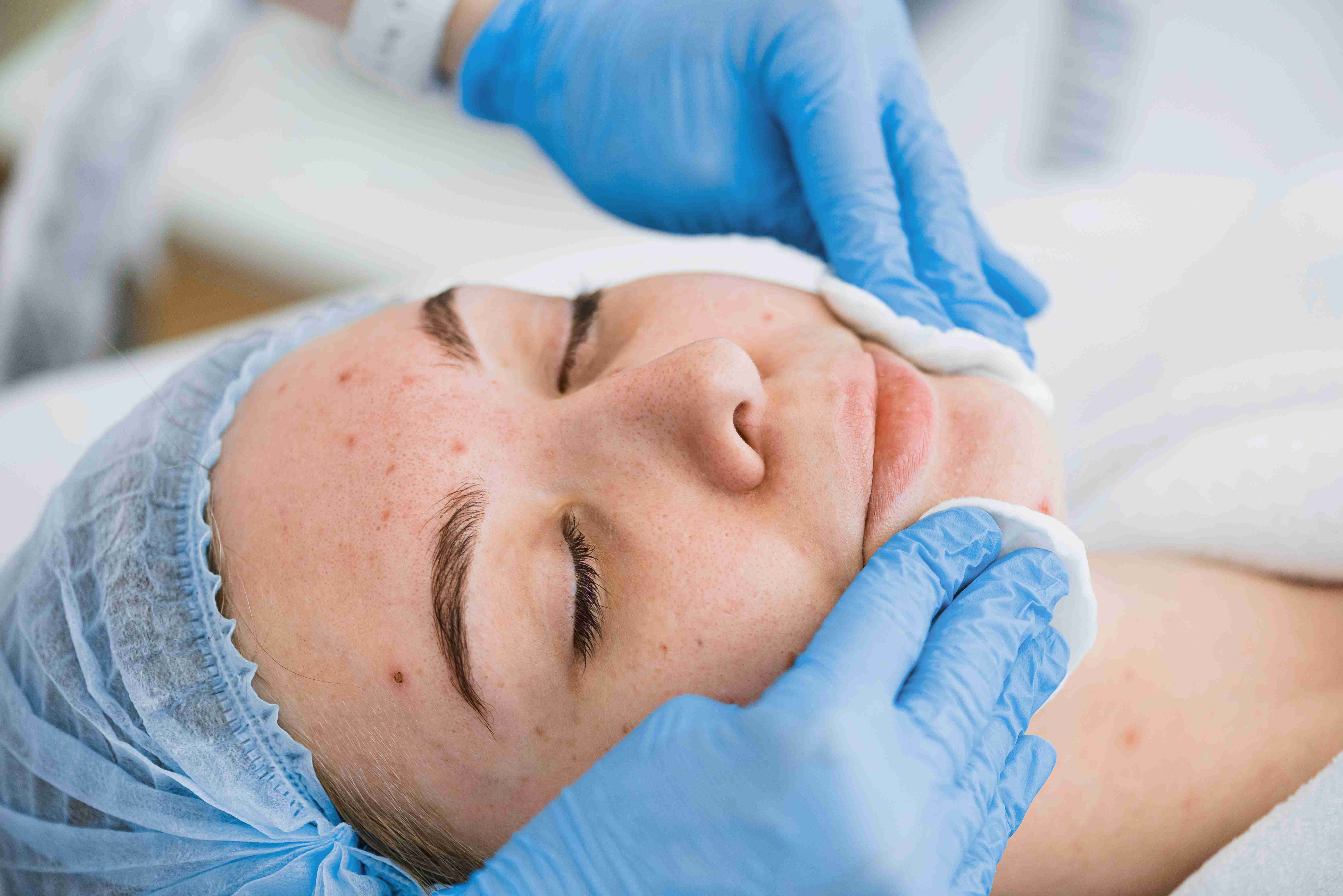 Laser pigmentation reduction session