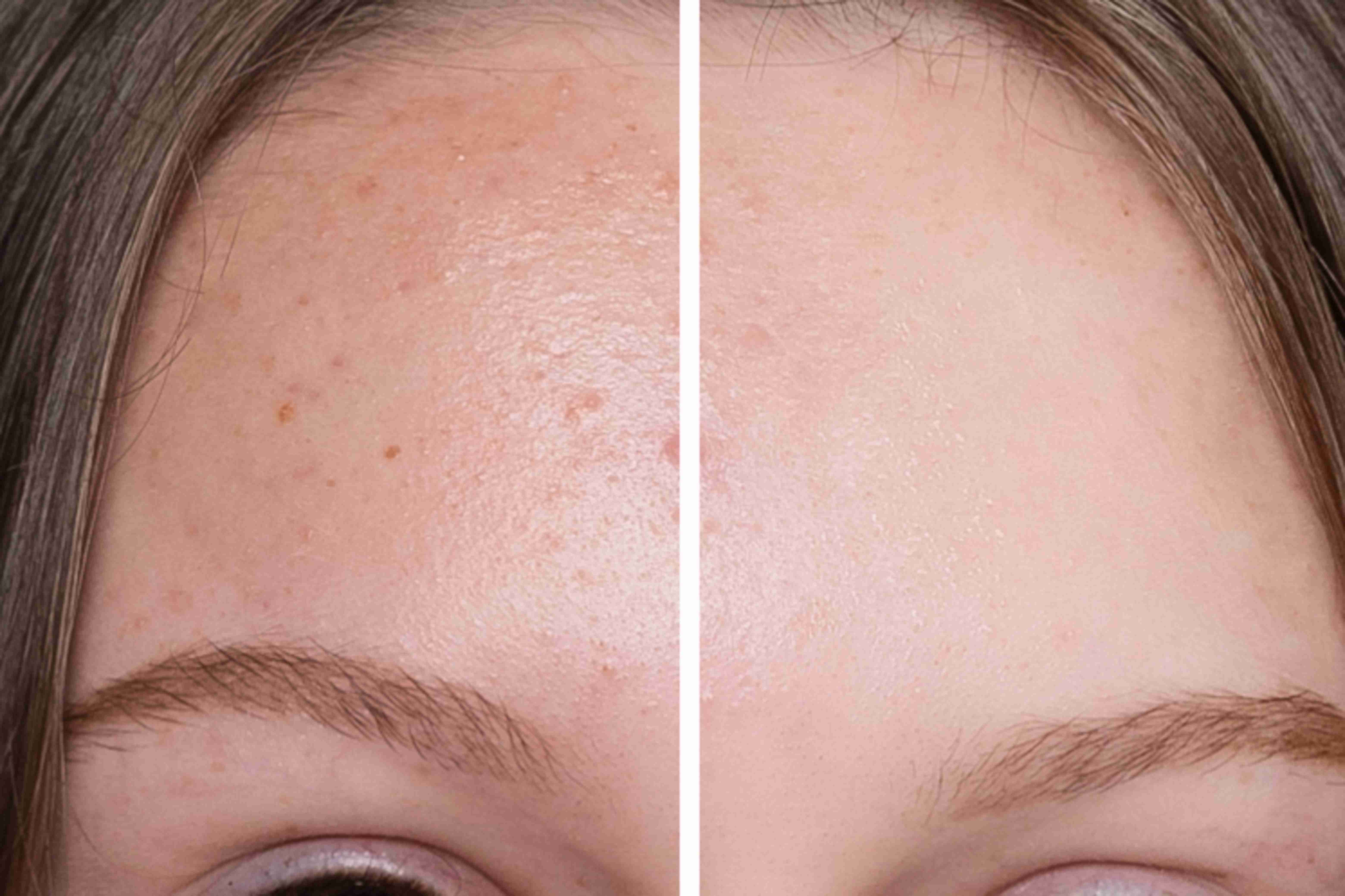 Pigment-free clear skin after laser