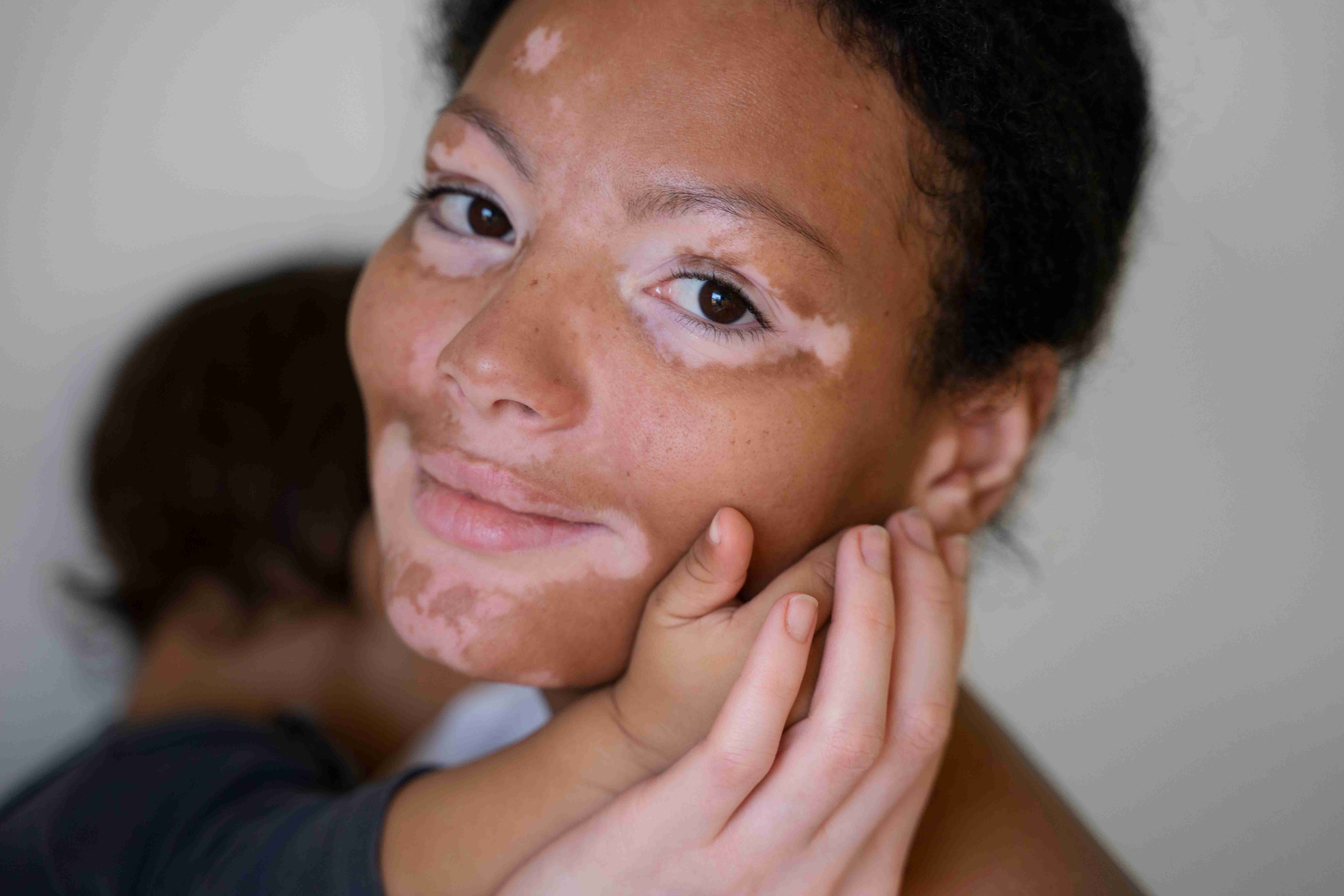 Steps in treating pseudo acanthosis nigricans
