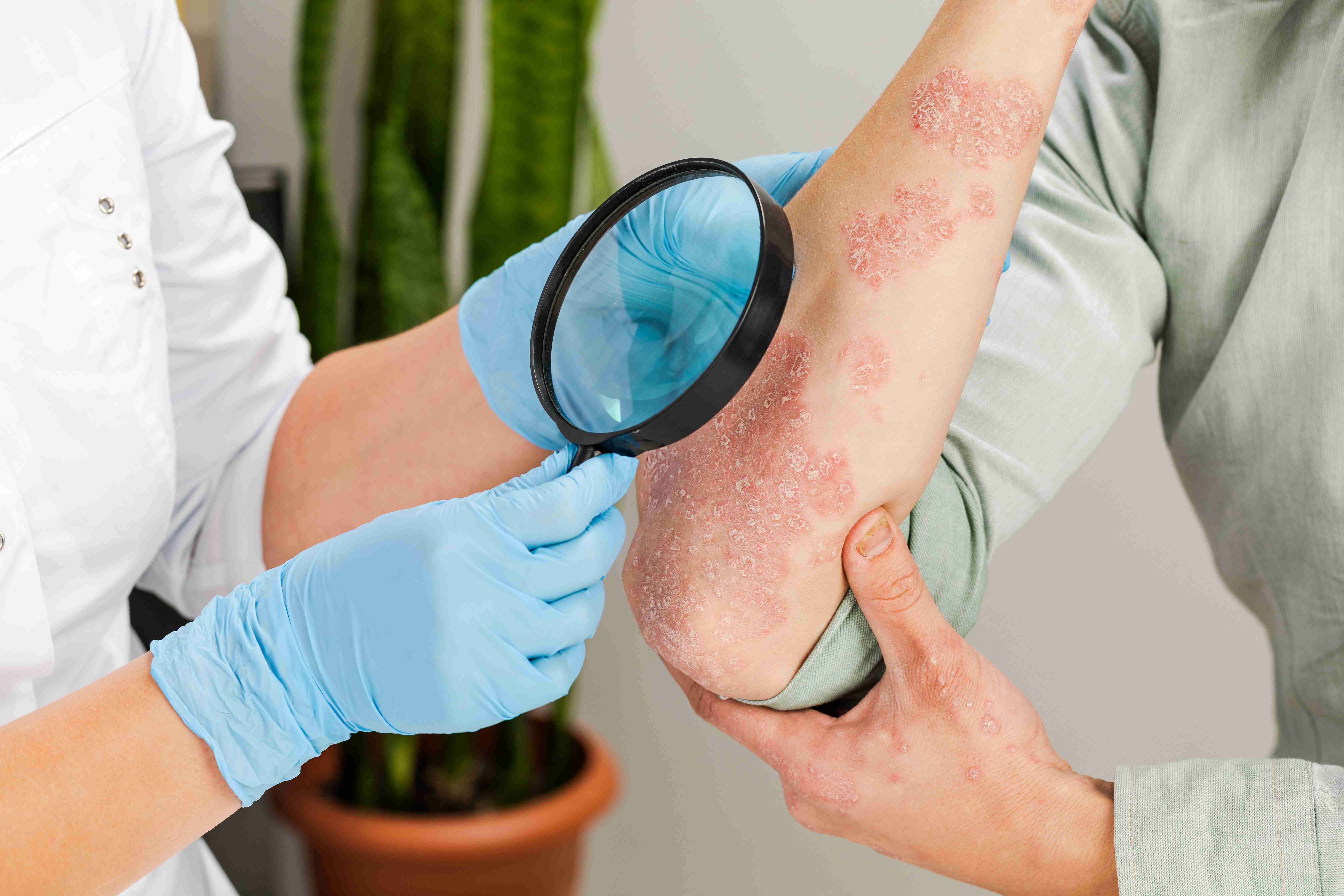 Common triggers of psoriasis flare-ups