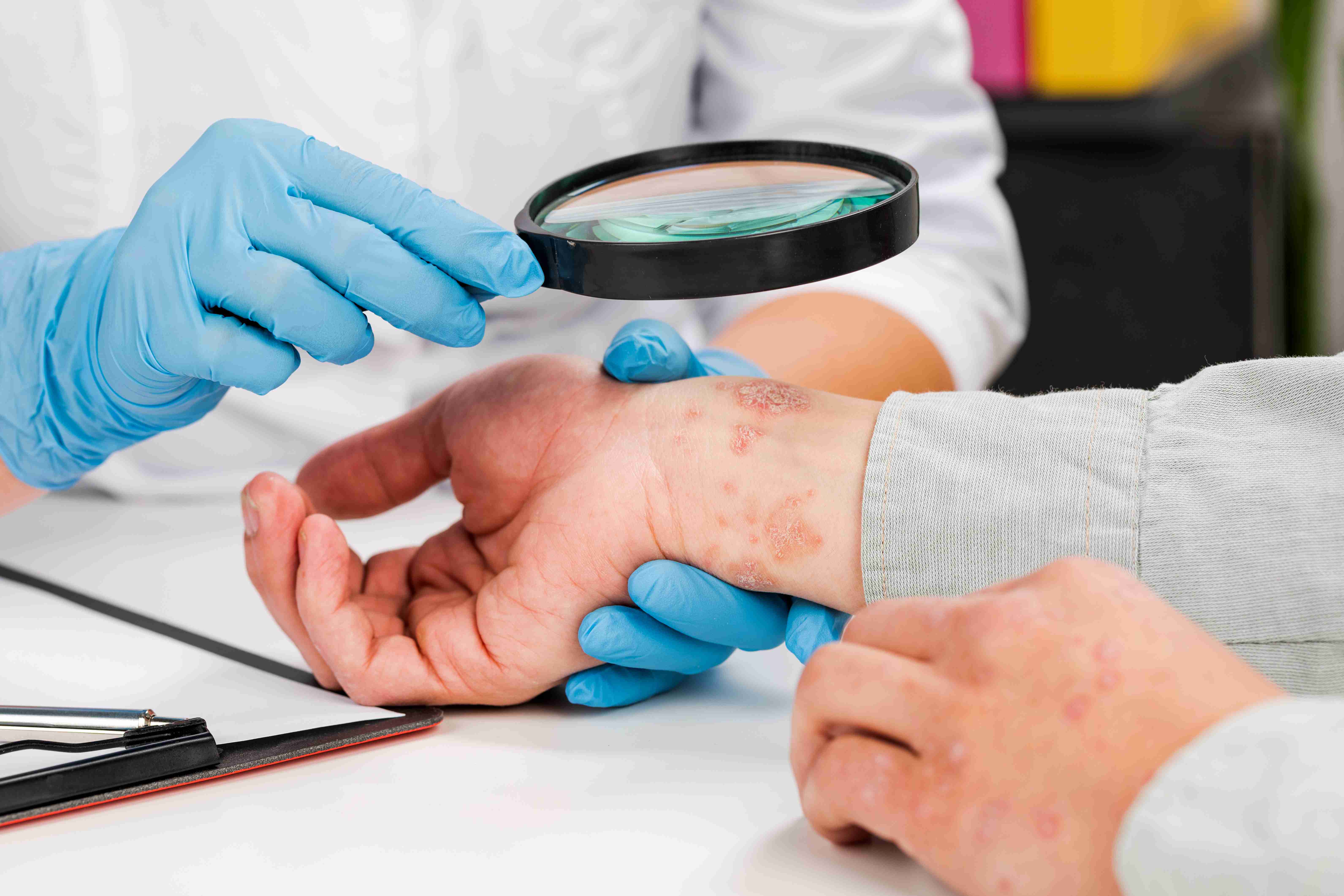 Psoriasis symptoms on elbows and scalp