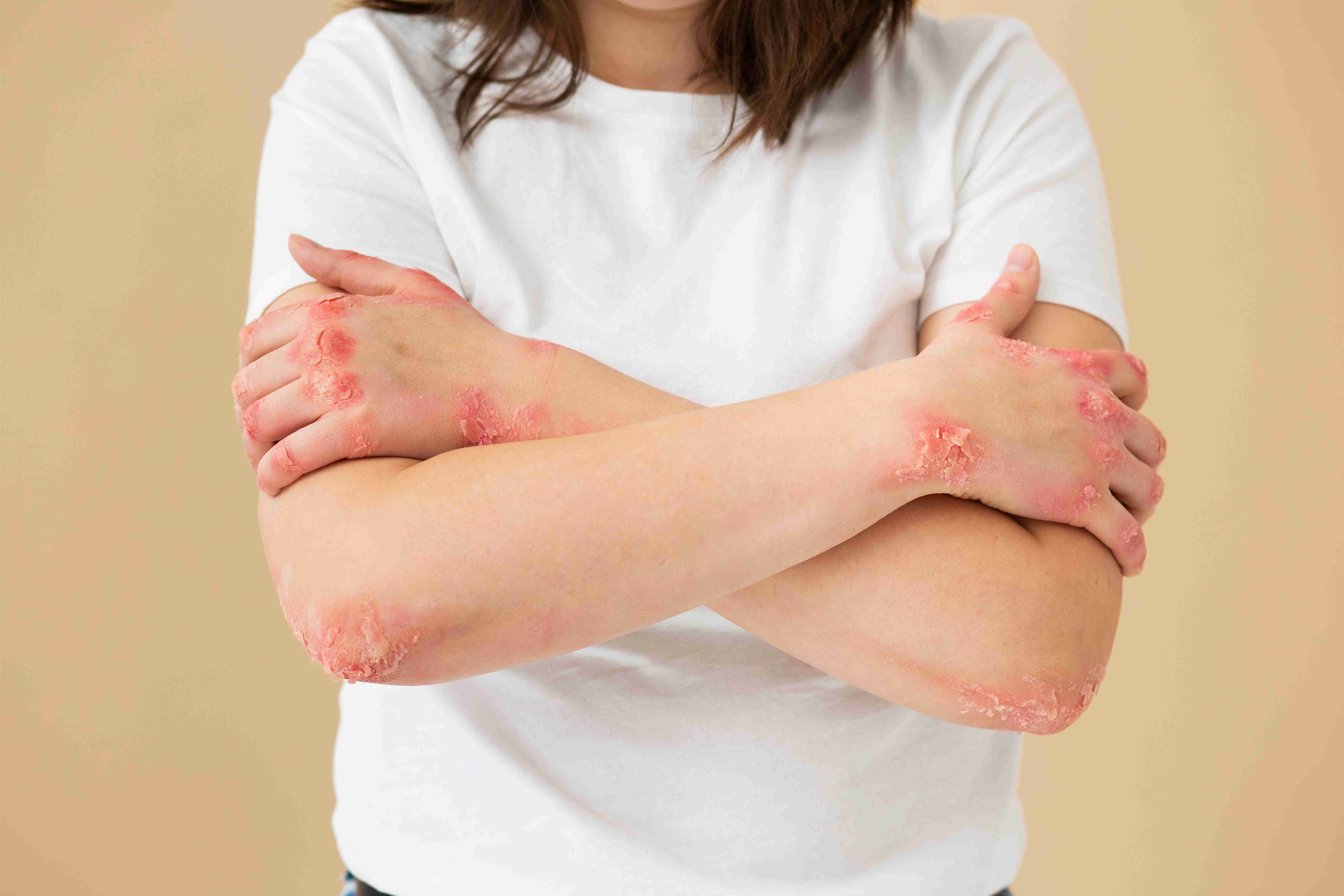 Dermatologist guiding psoriasis treatment