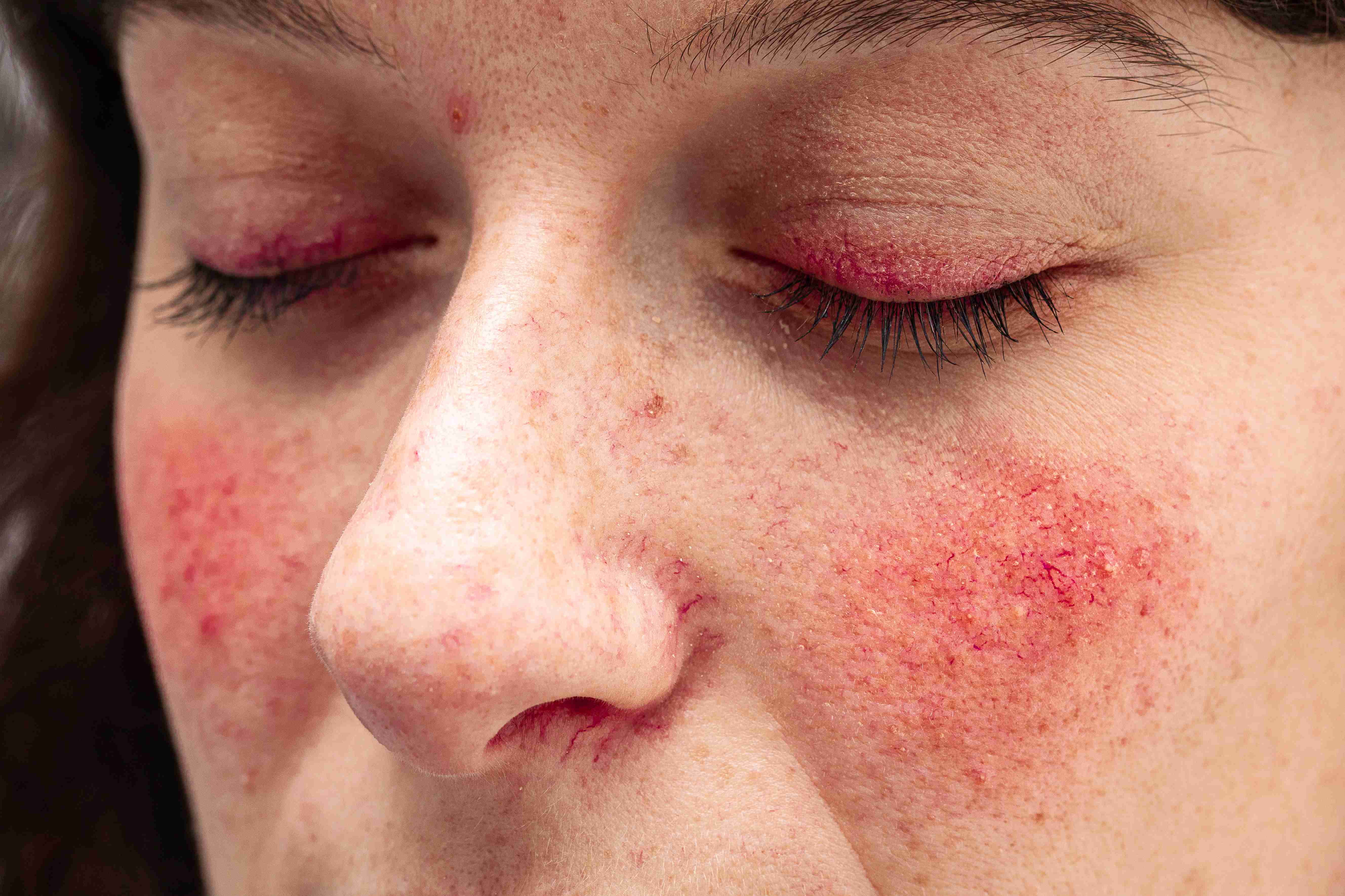 Rosacea on nose and cheeks