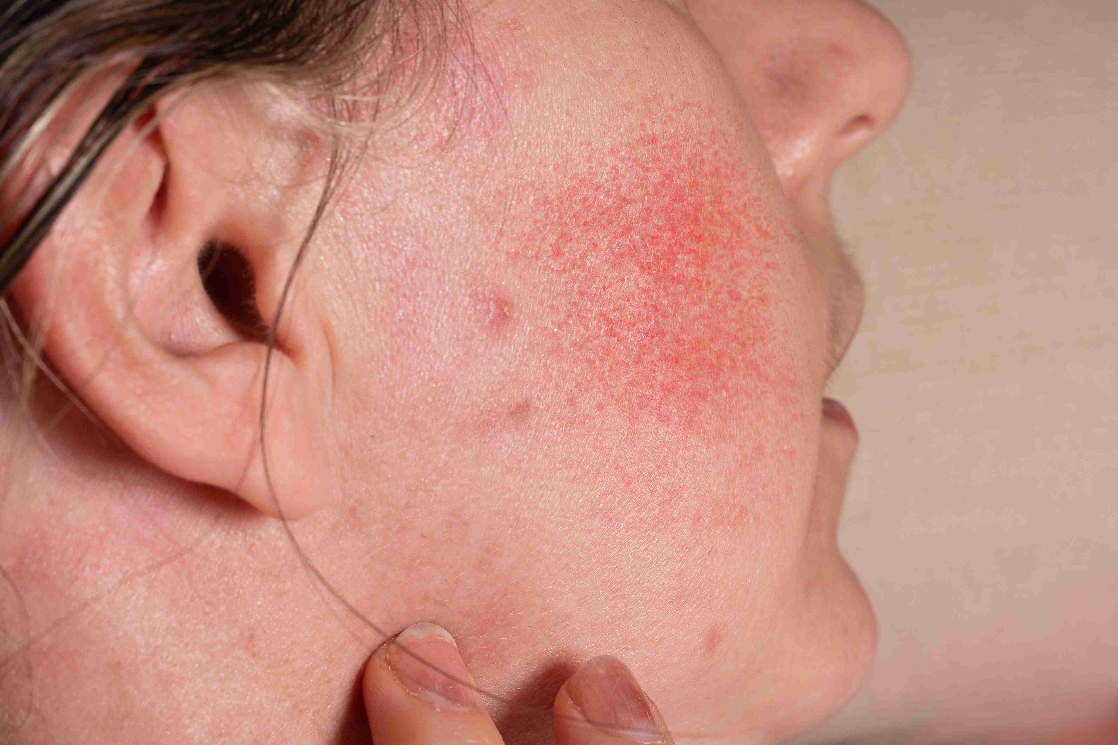 Rosacea flare-up due to stress