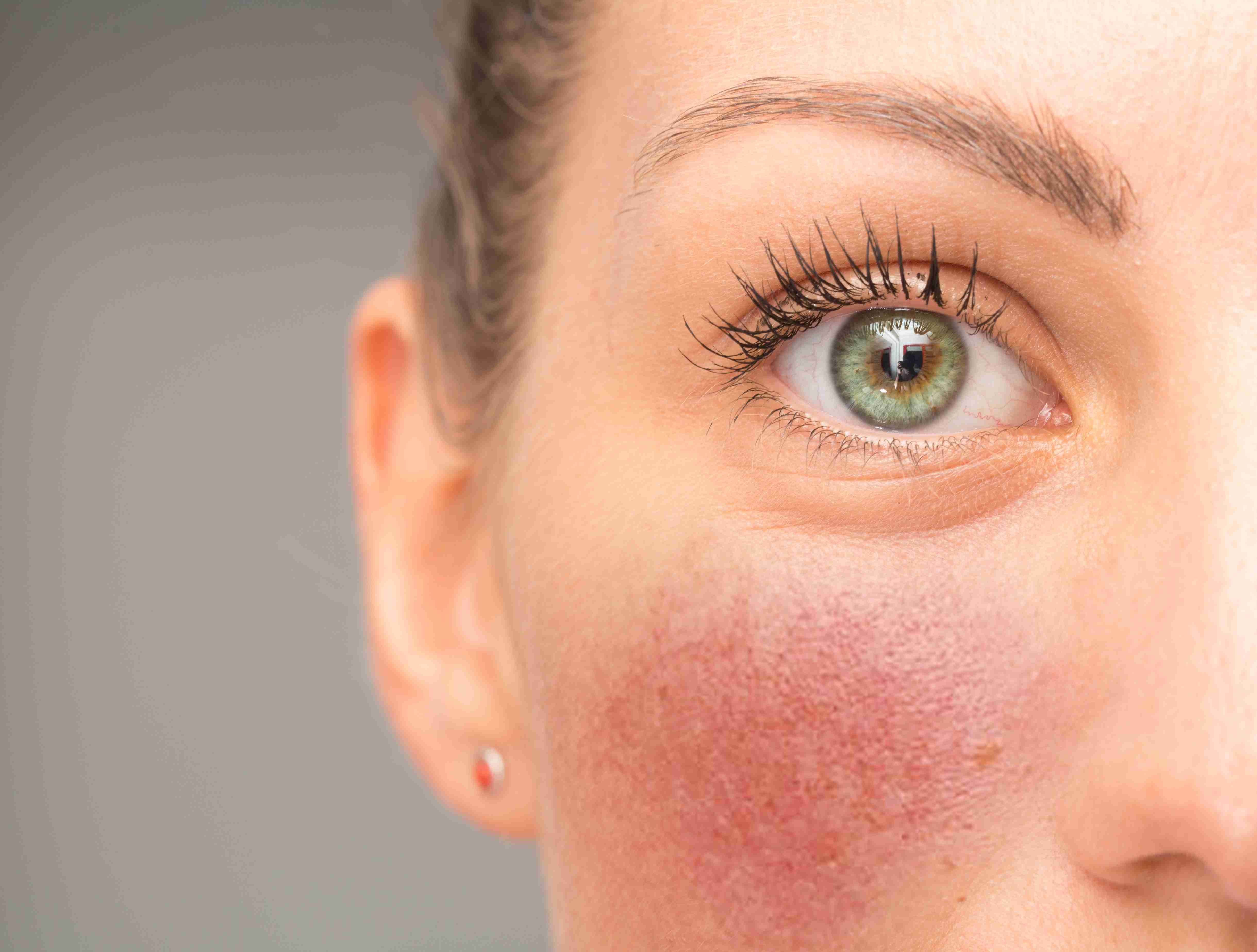 Skin improvement after rosacea treatment