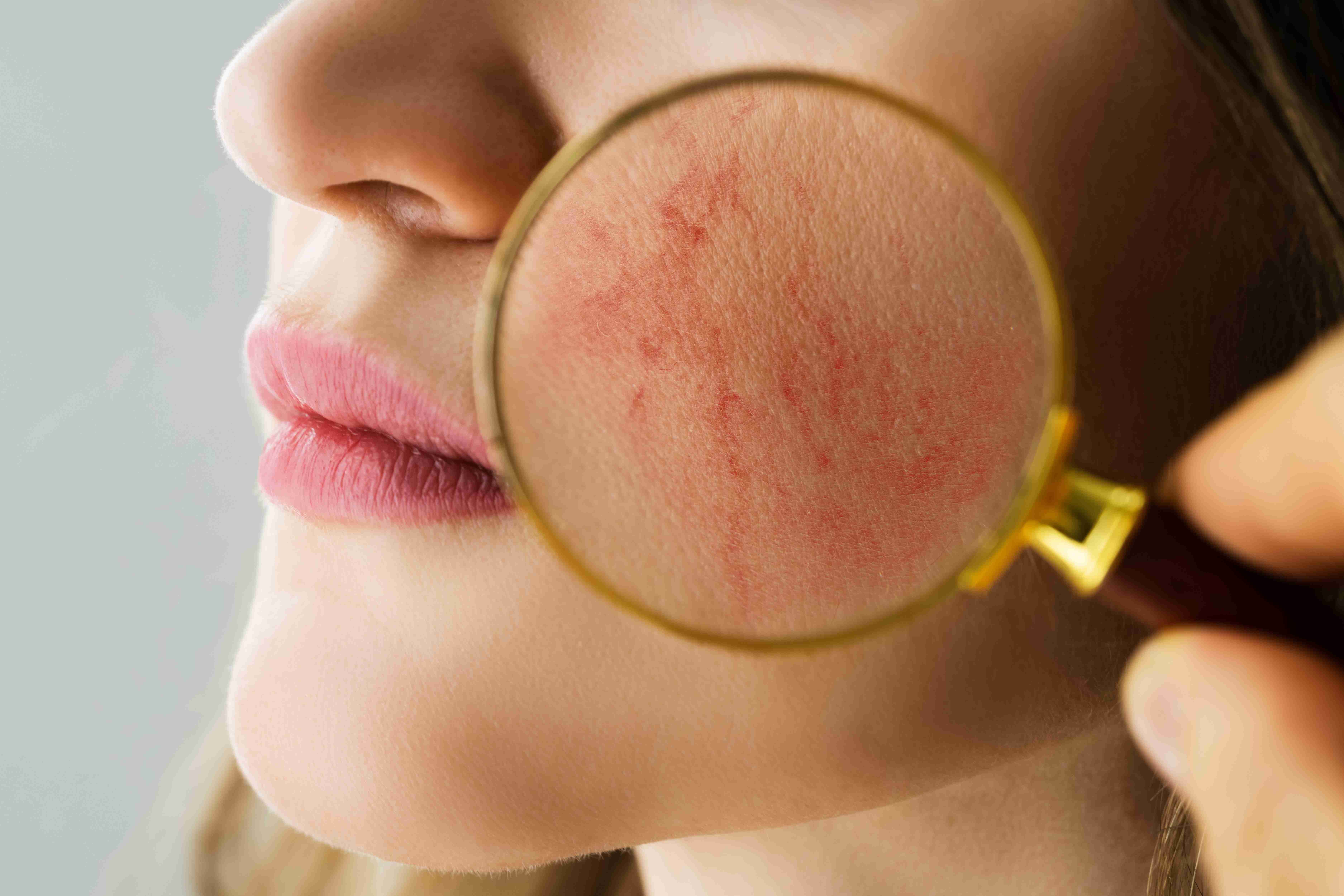 Steps of rosacea care