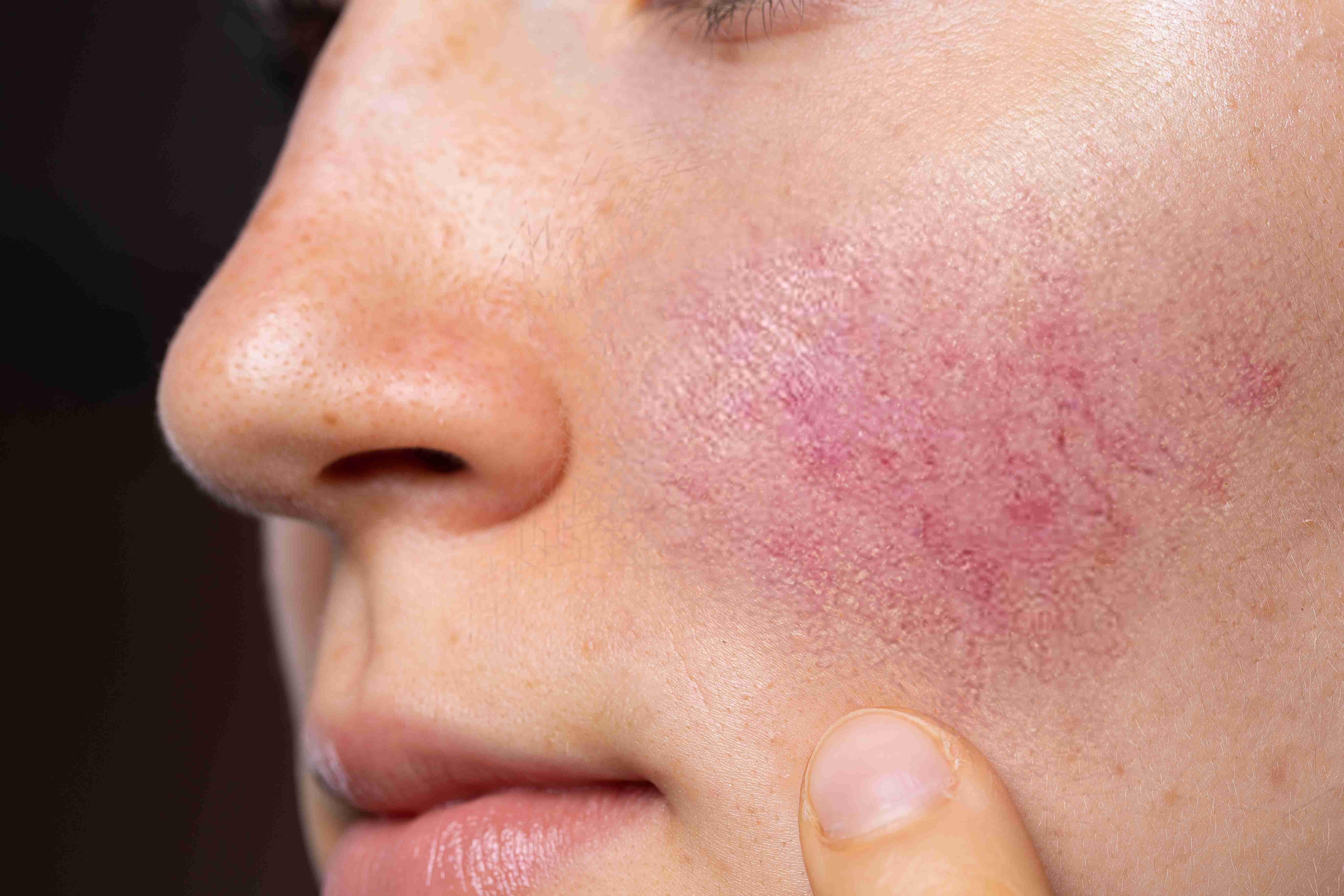 Rosacea treatment results