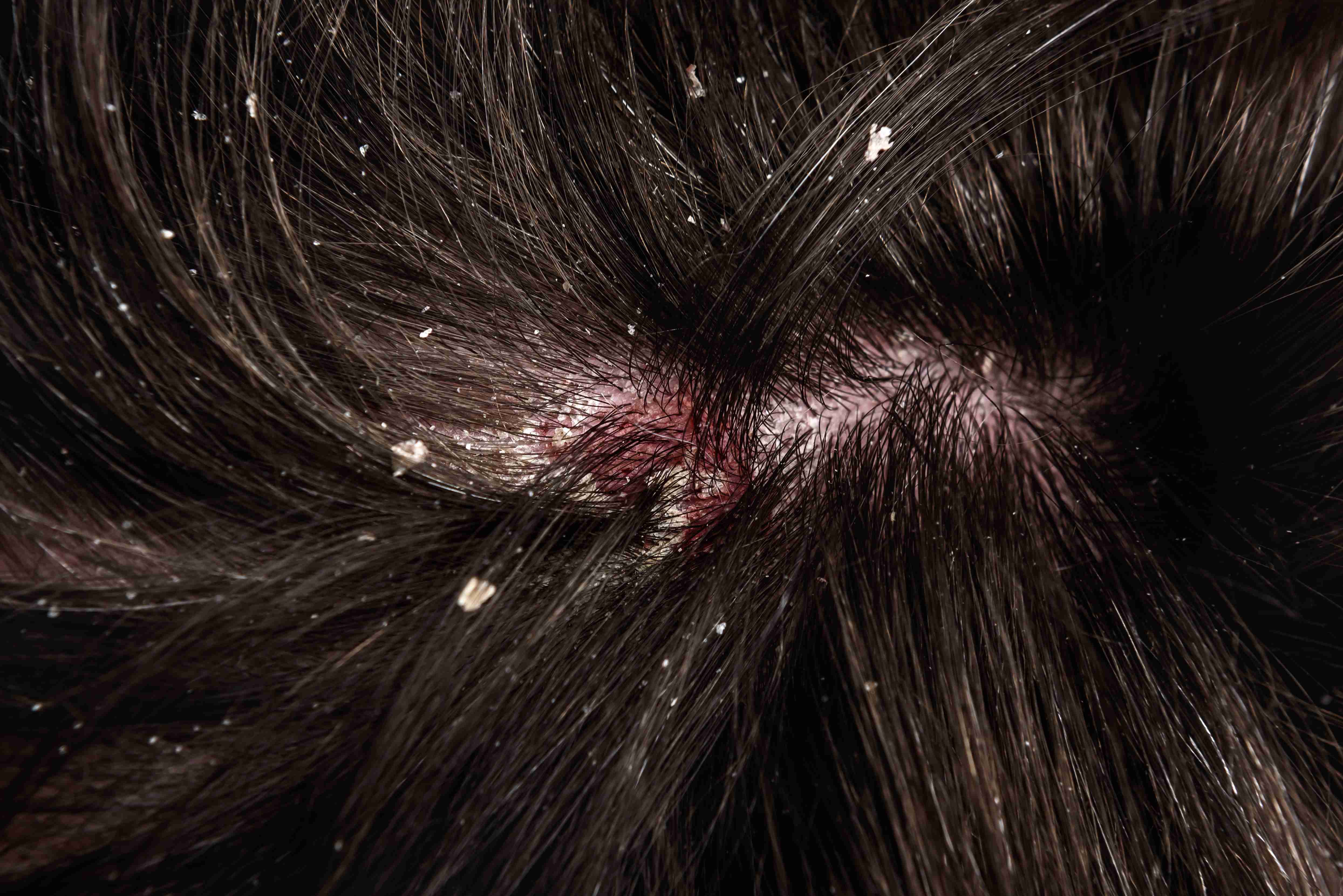 Causes of seborrheic dermatitis on scalp and face