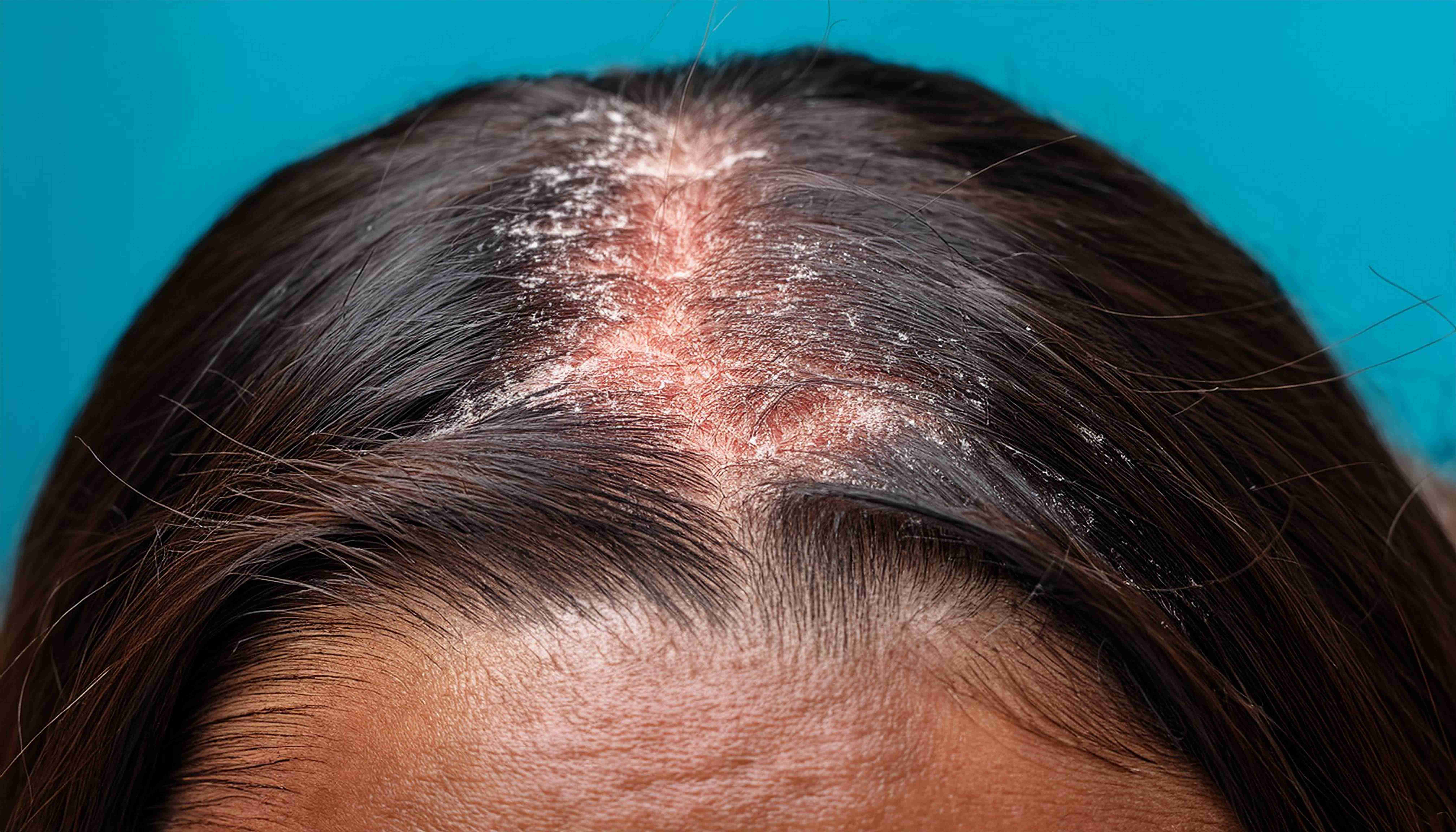 Seborrheic dermatitis on scalp and forehead