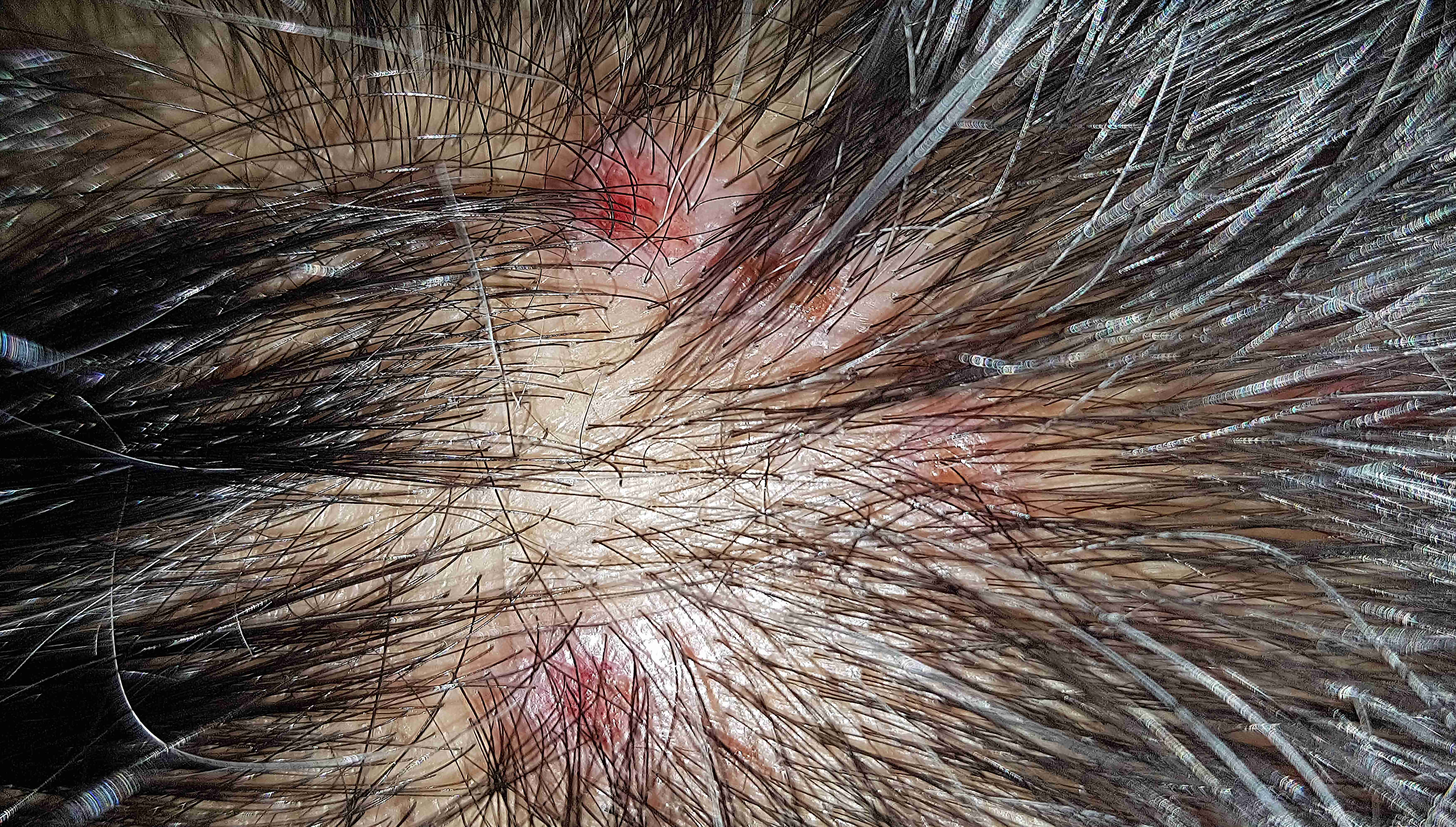 Shampoo and treatment for seborrheic dermatitis