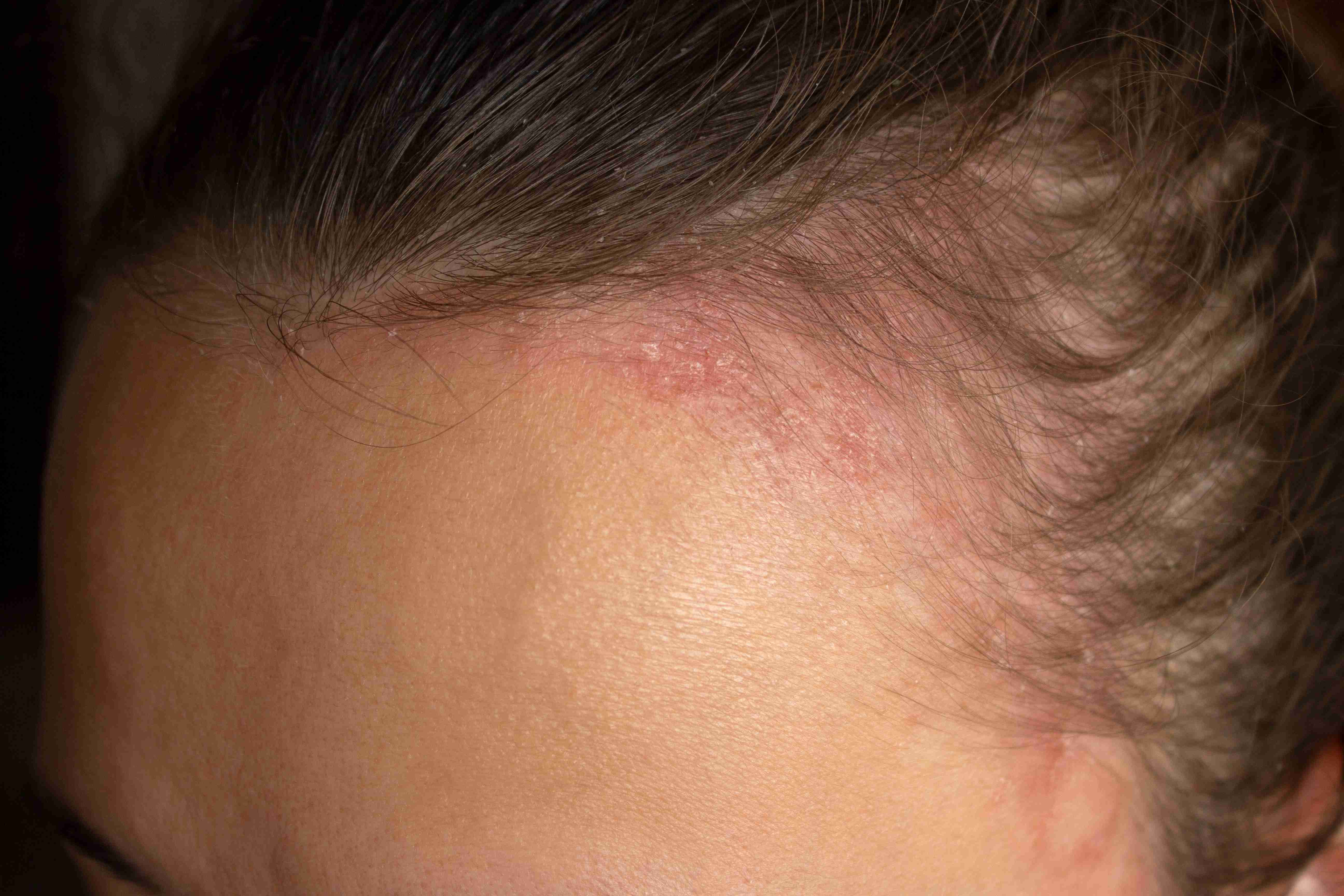 Dermatologist evaluating flaky skin