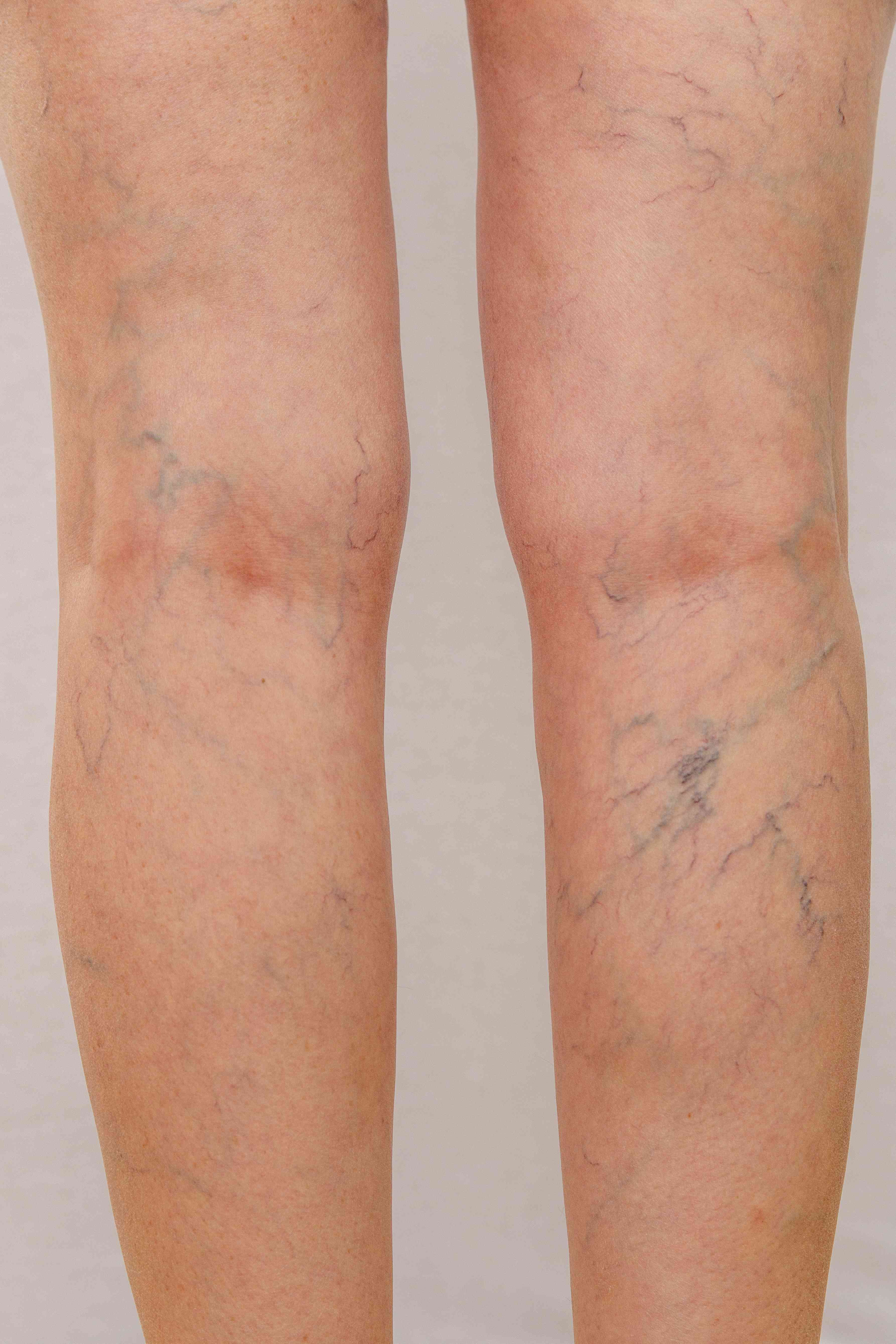 Common causes of spider veins