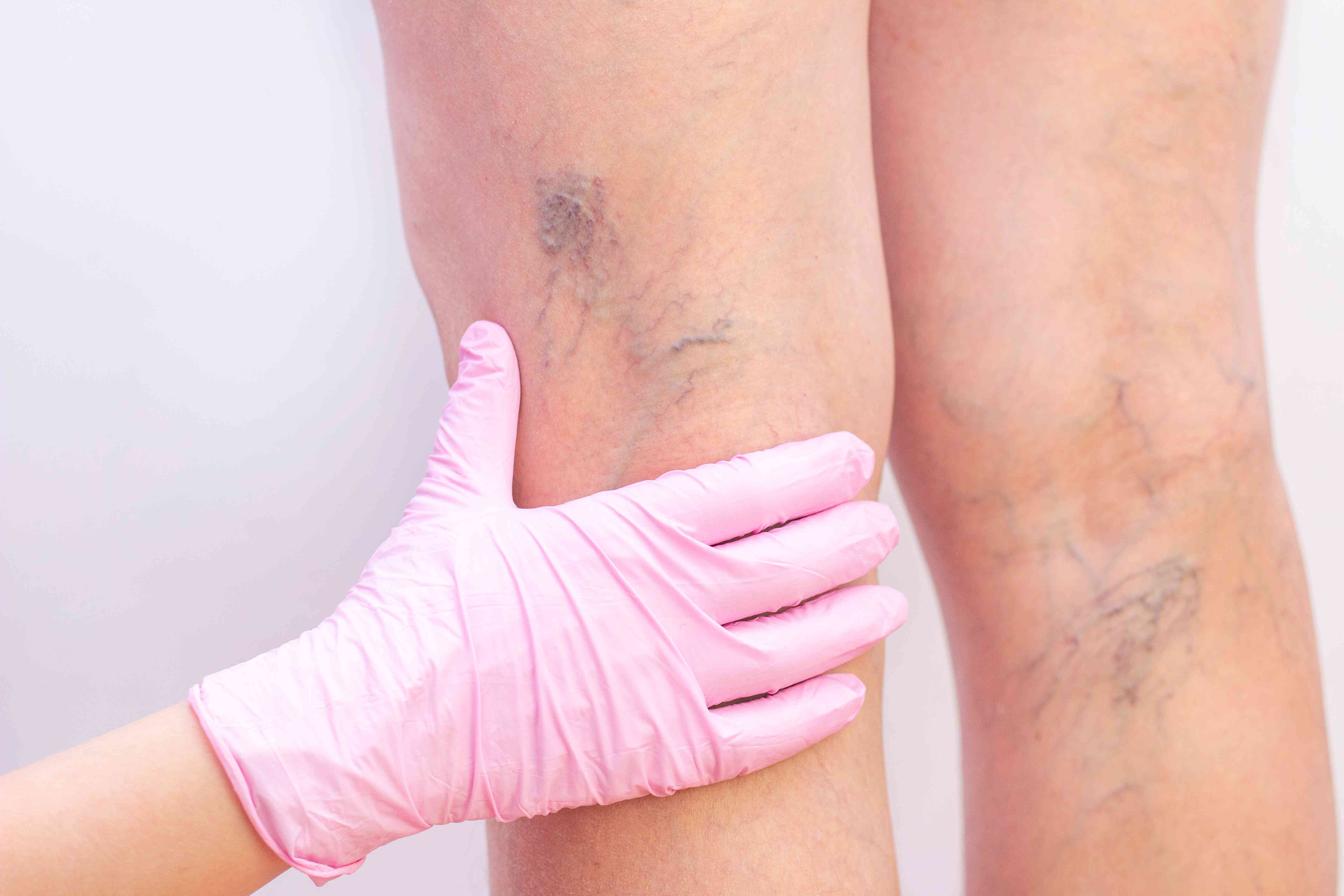 Spider veins on face and legs