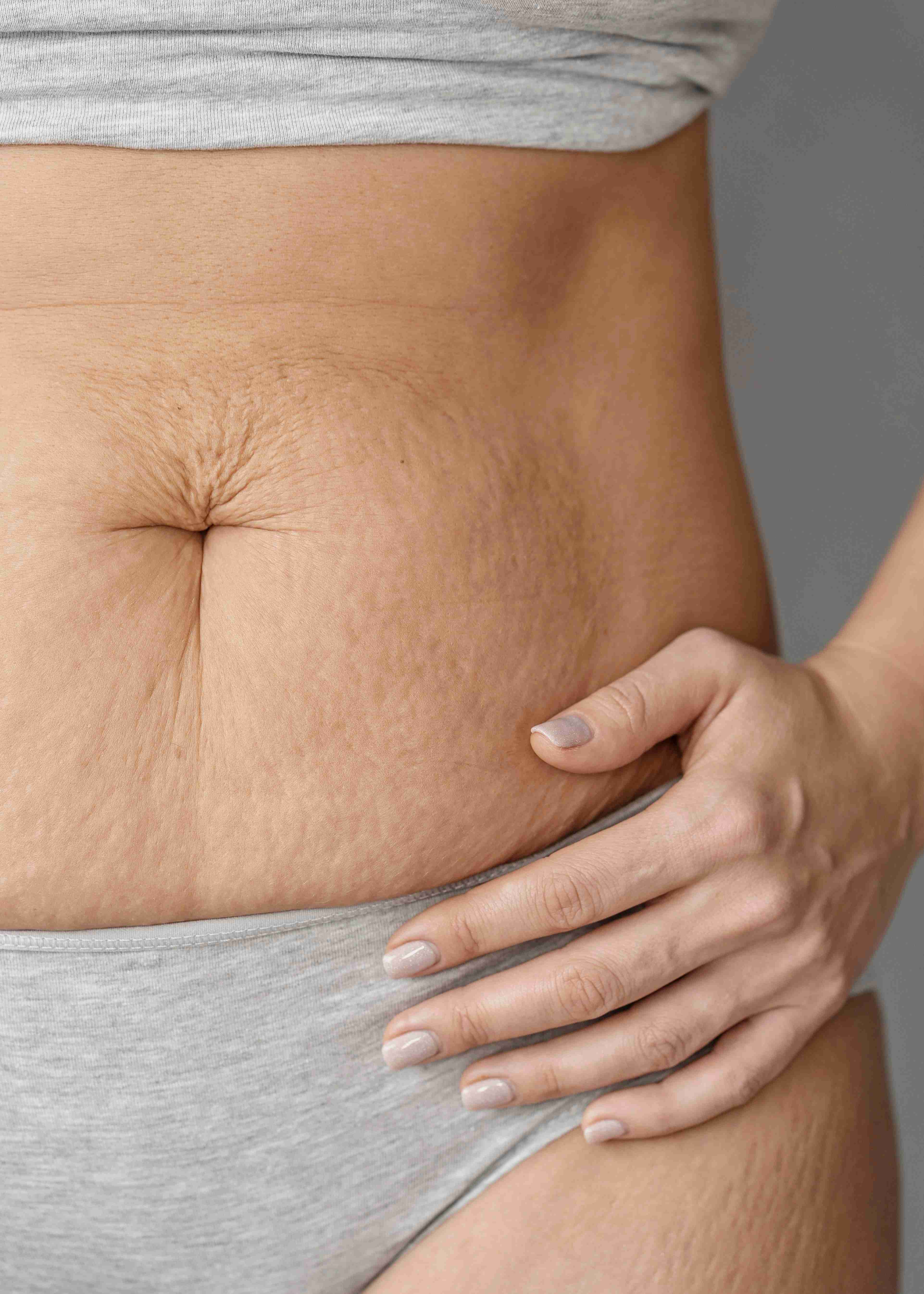 Stretch marks on abdomen and thighs