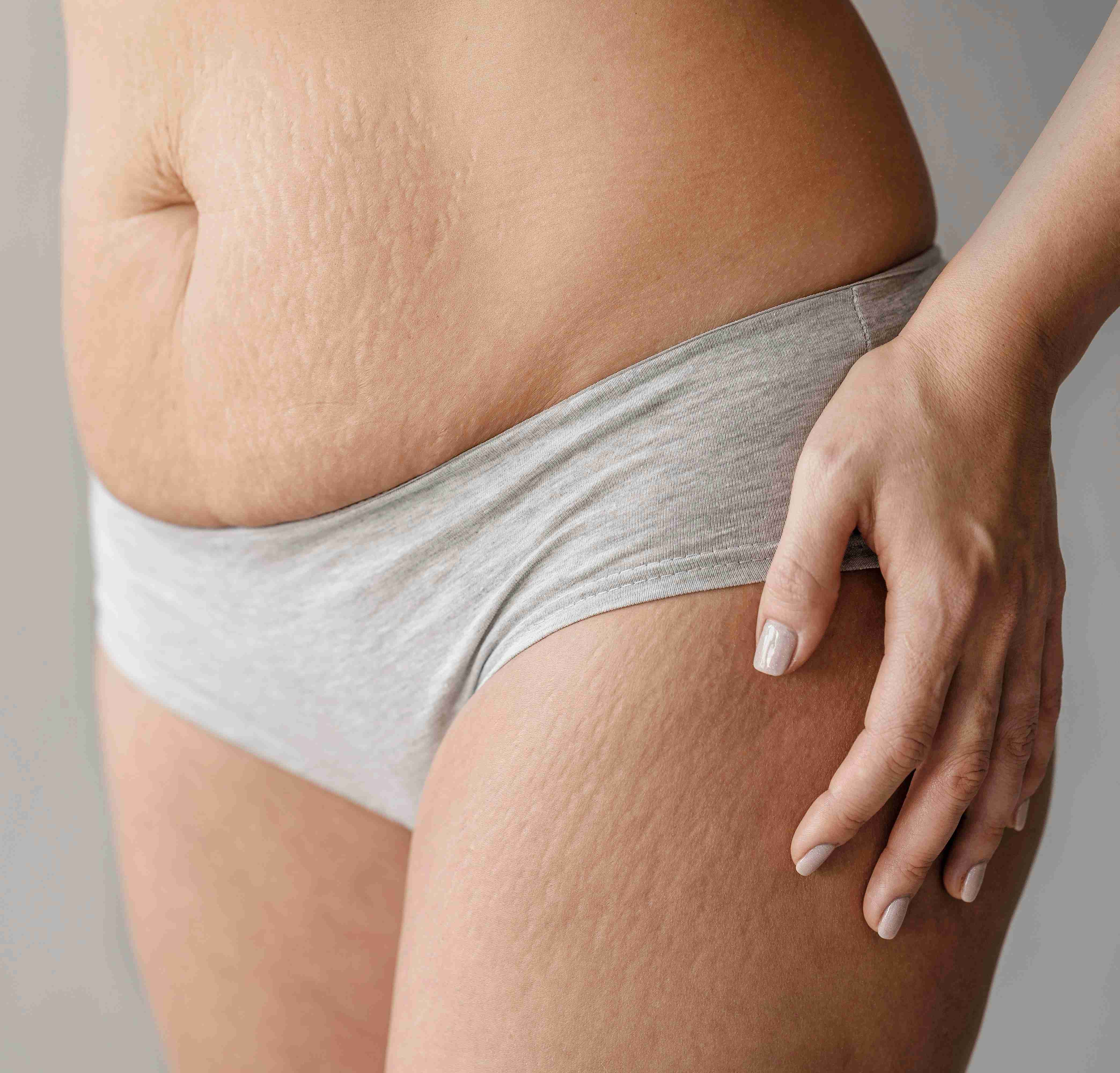 Factors that lead to stretch marks formation