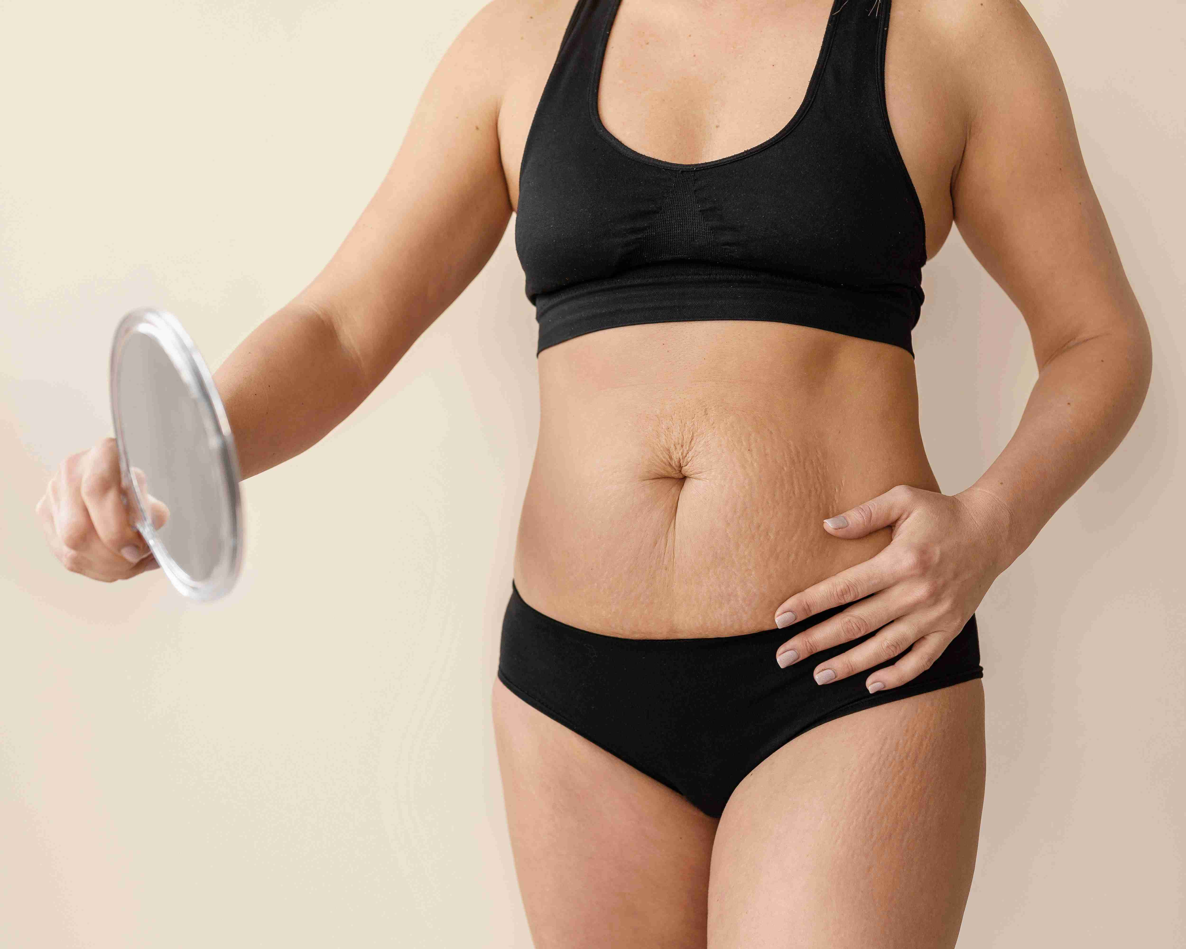 Different types of stretch marks on skin