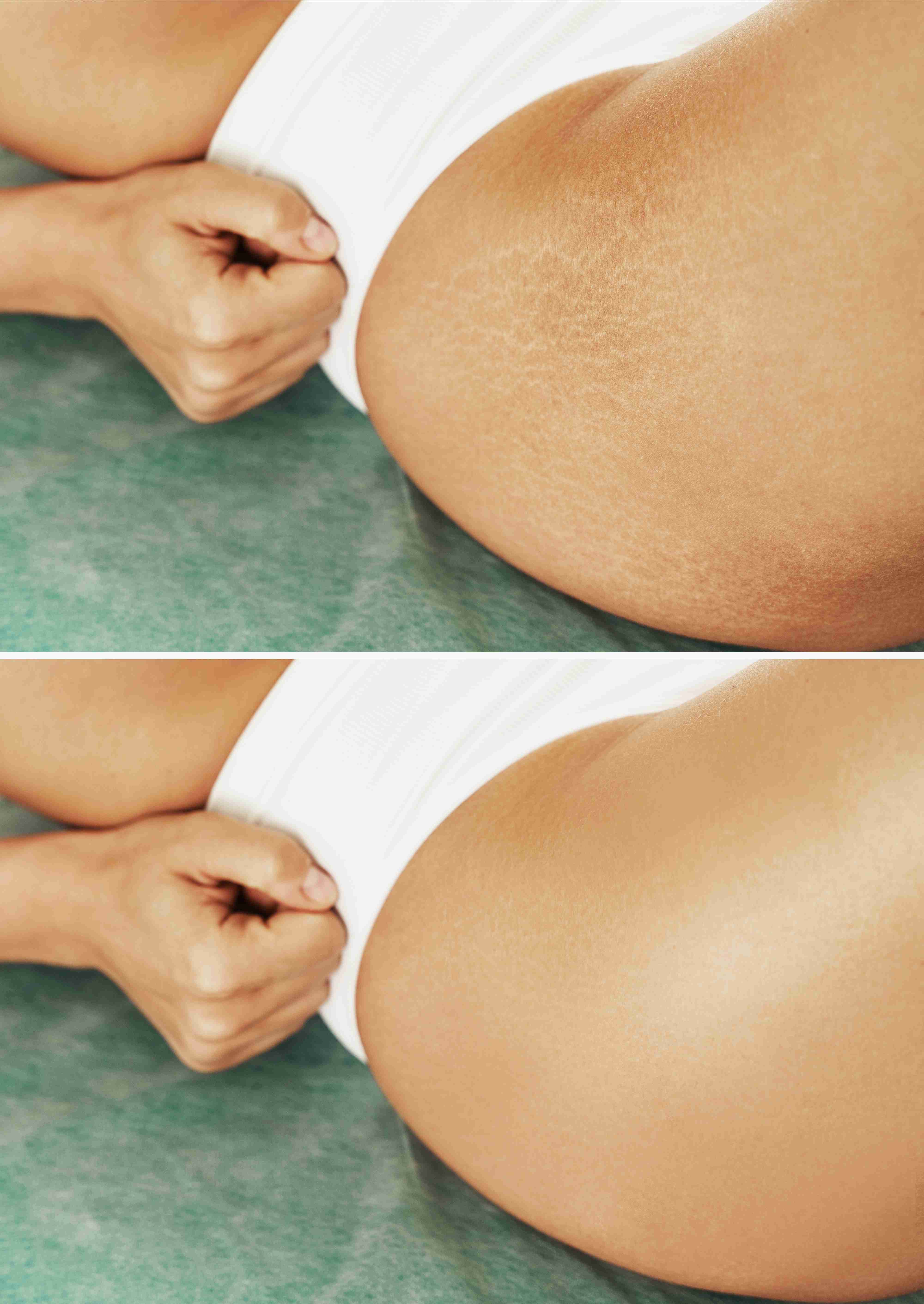 Dermatological stretch mark treatments