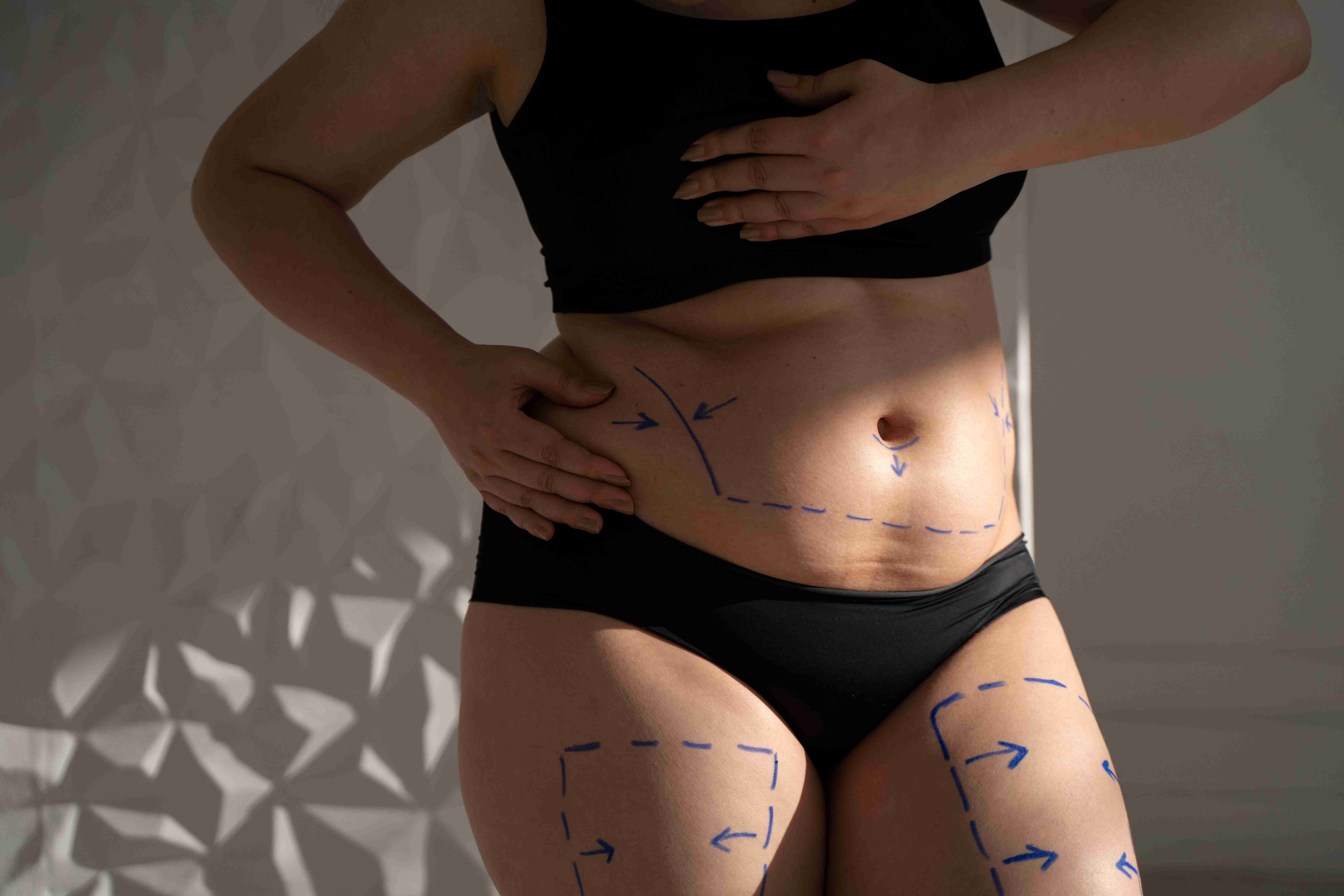 In-clinic procedure for stretch mark treatment