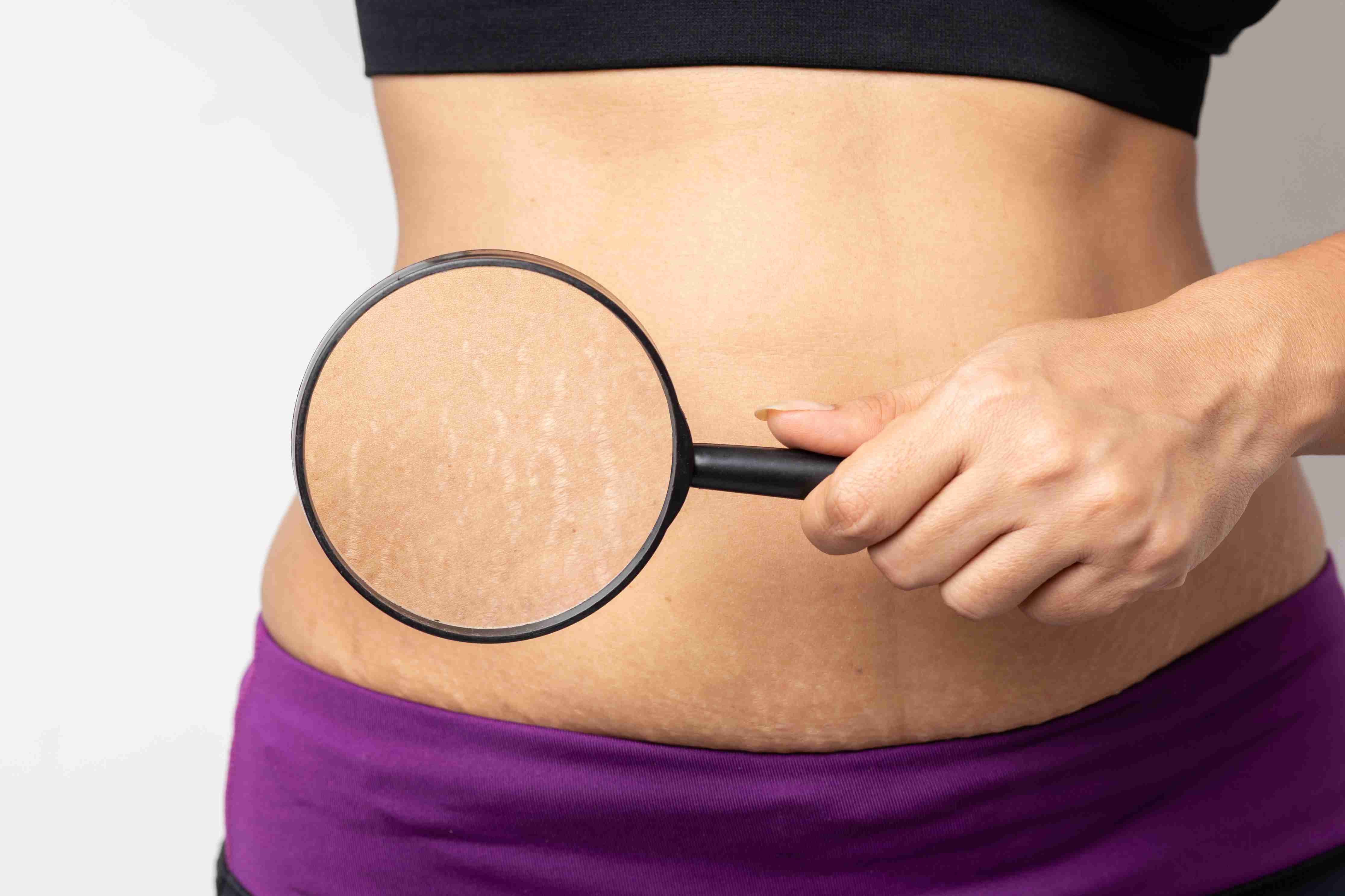 Before and after stretch mark treatment