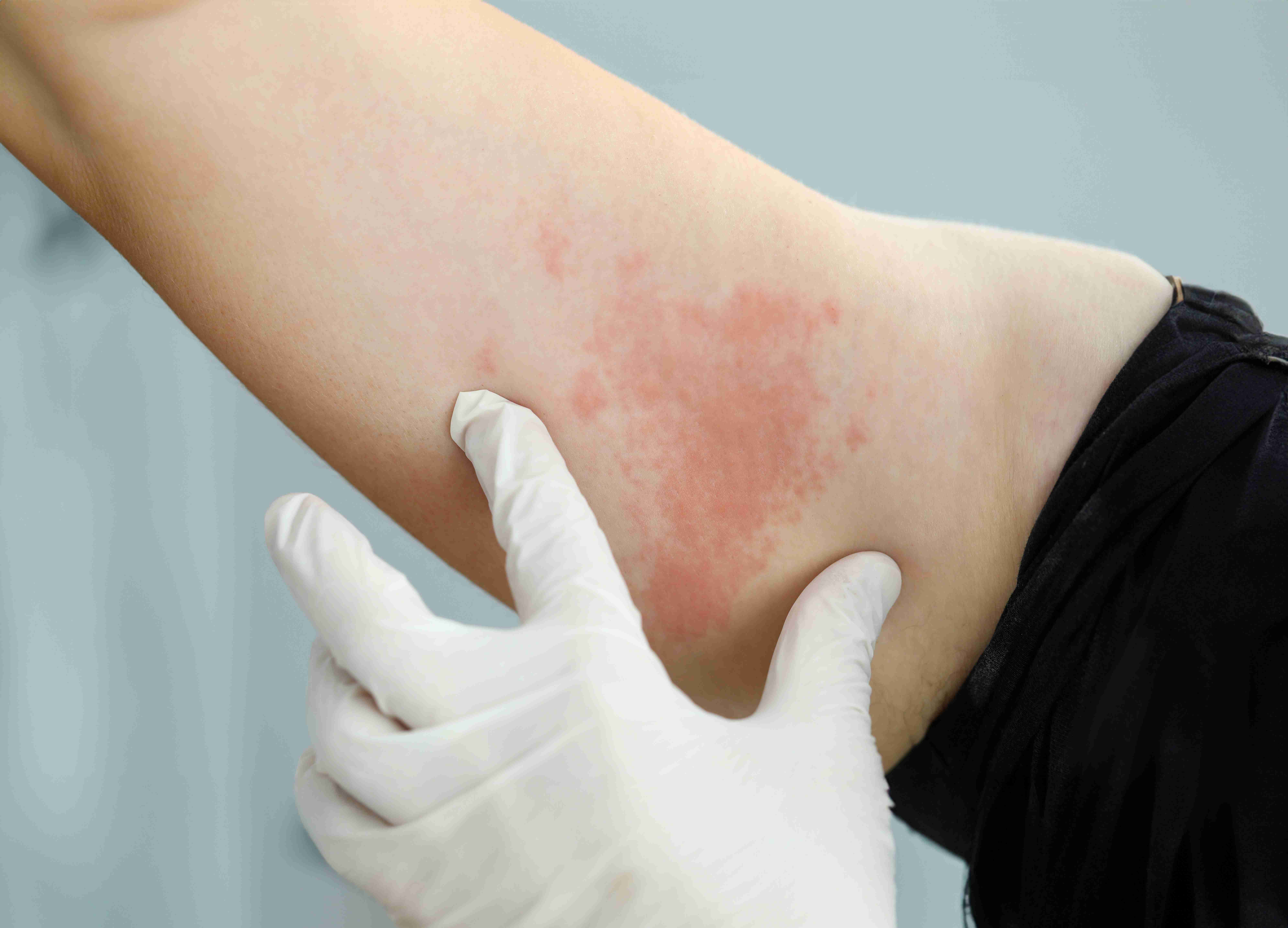 Urticaria