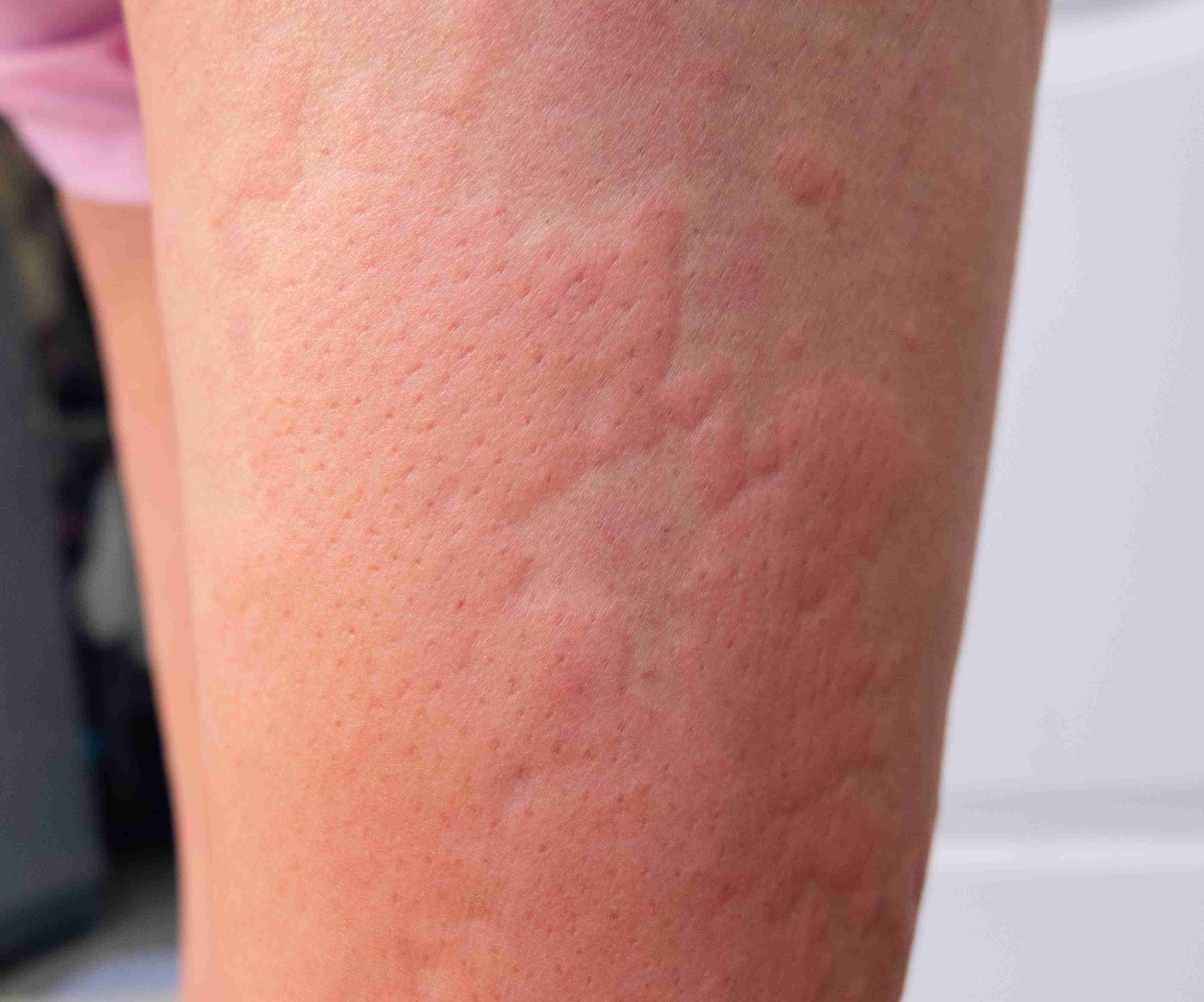 Red itchy wheals on arms due to urticaria
