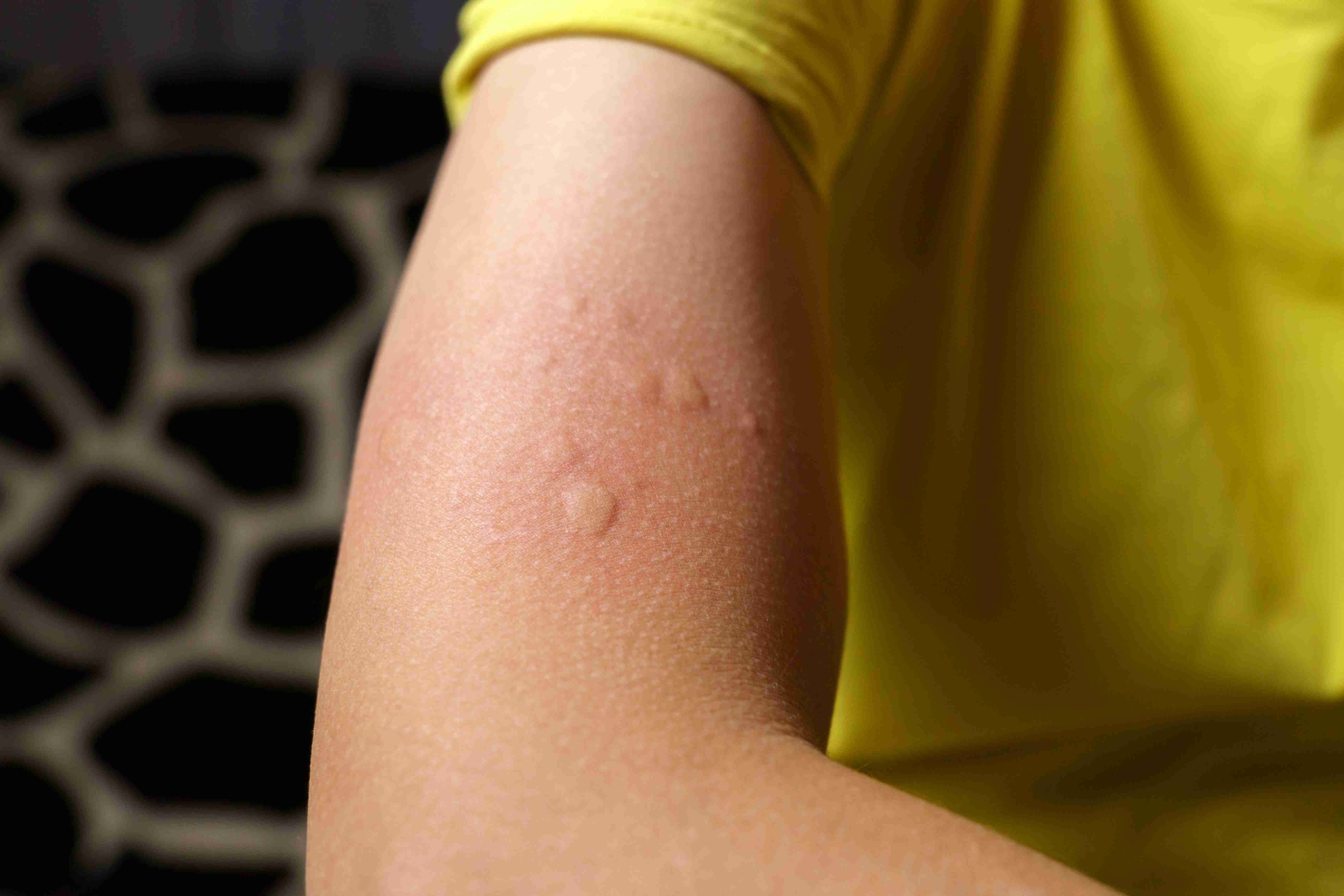 Types of urticaria explained
